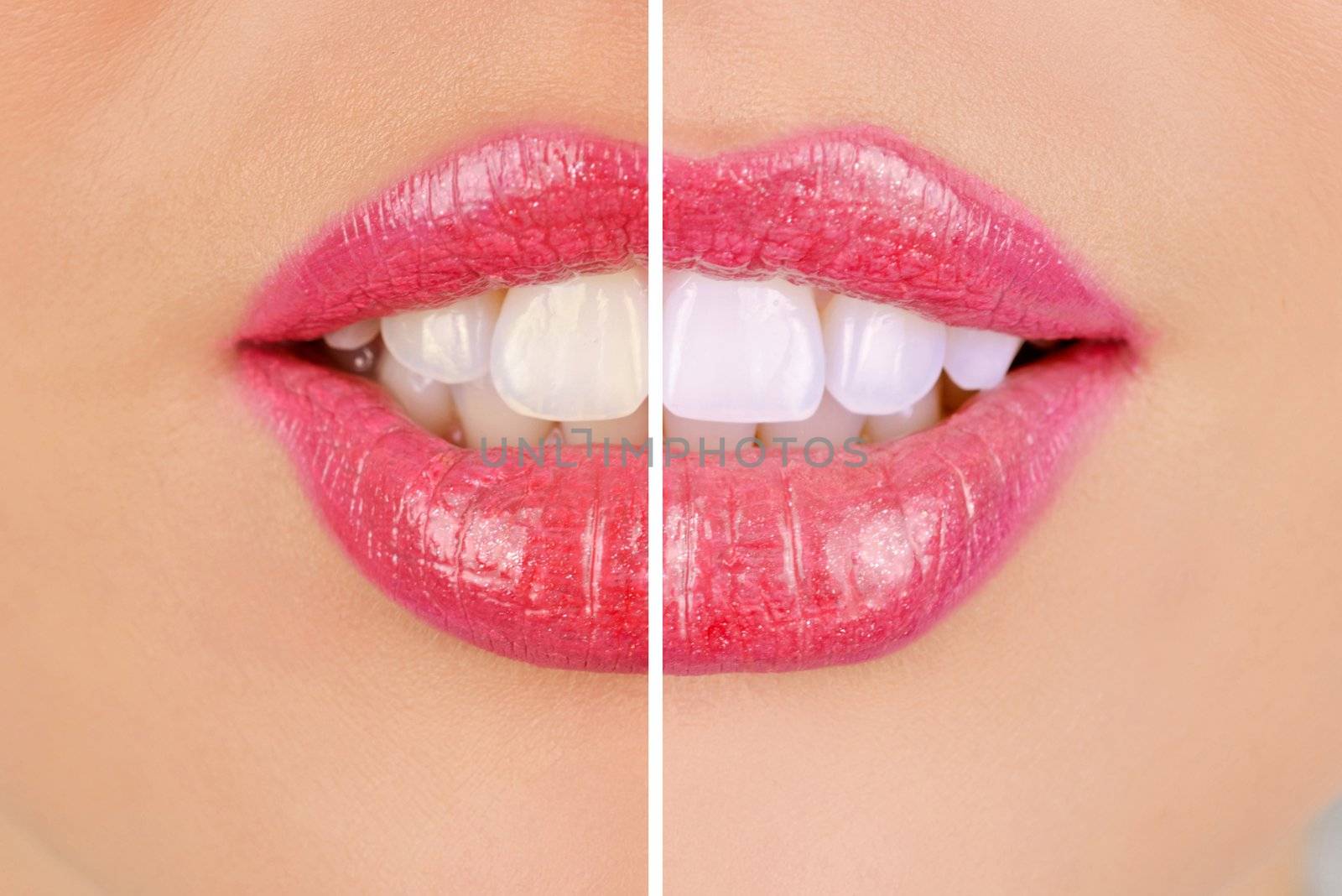 woman teeth before and after whitening