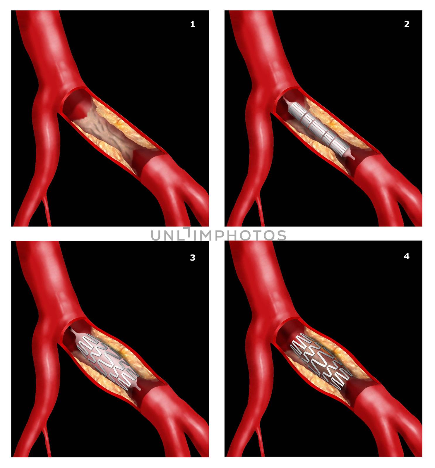 coronary stent by alexonline