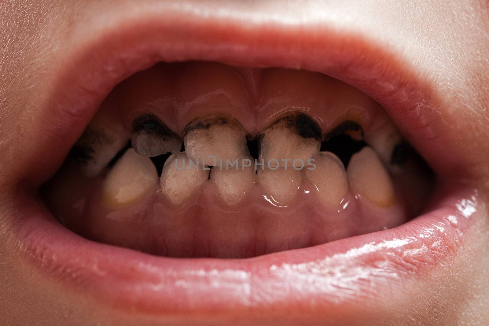 Caries teeth decay by ia_64