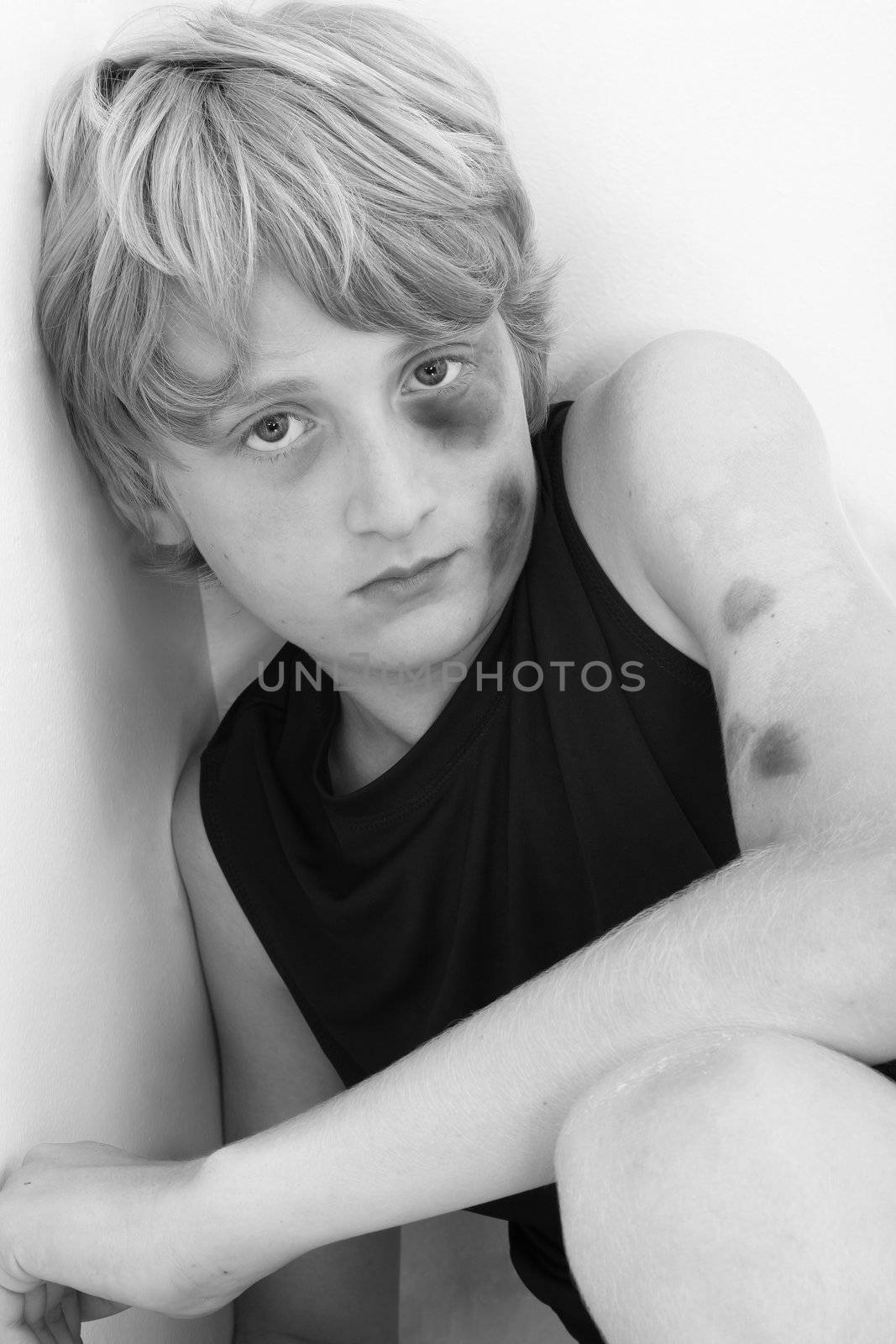 Close up of a young teen boy child with swollen brused eye and face in black and white.