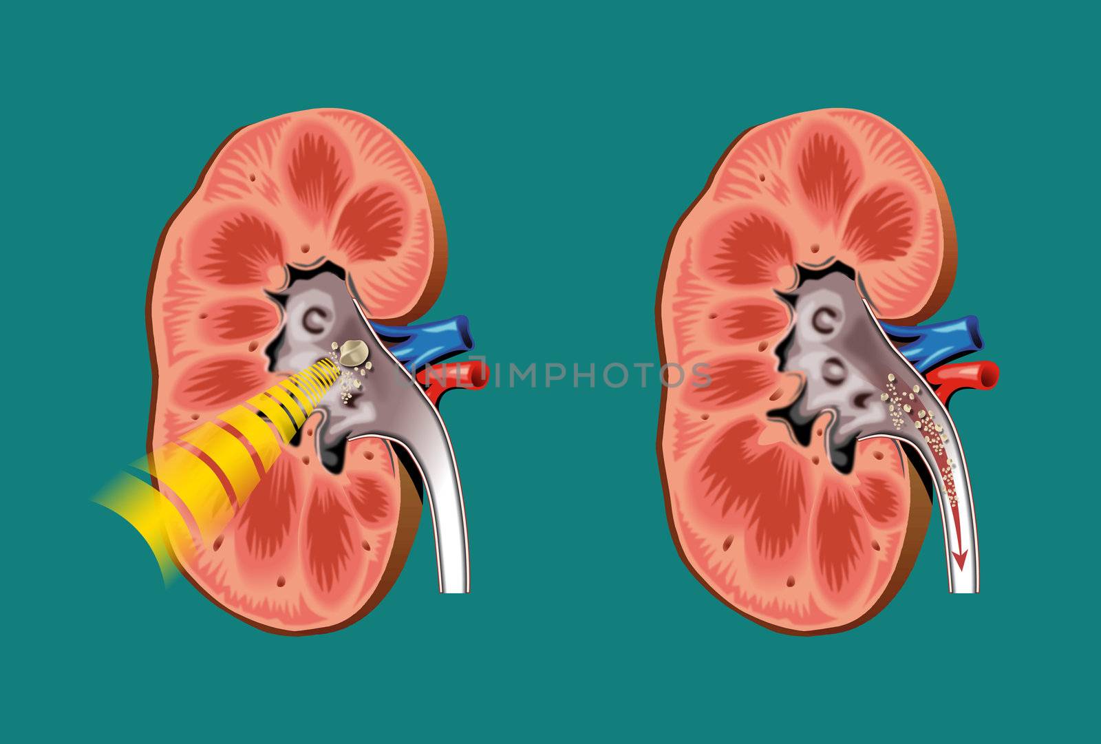 Schematic drawing of lithotripsy in kidney stones