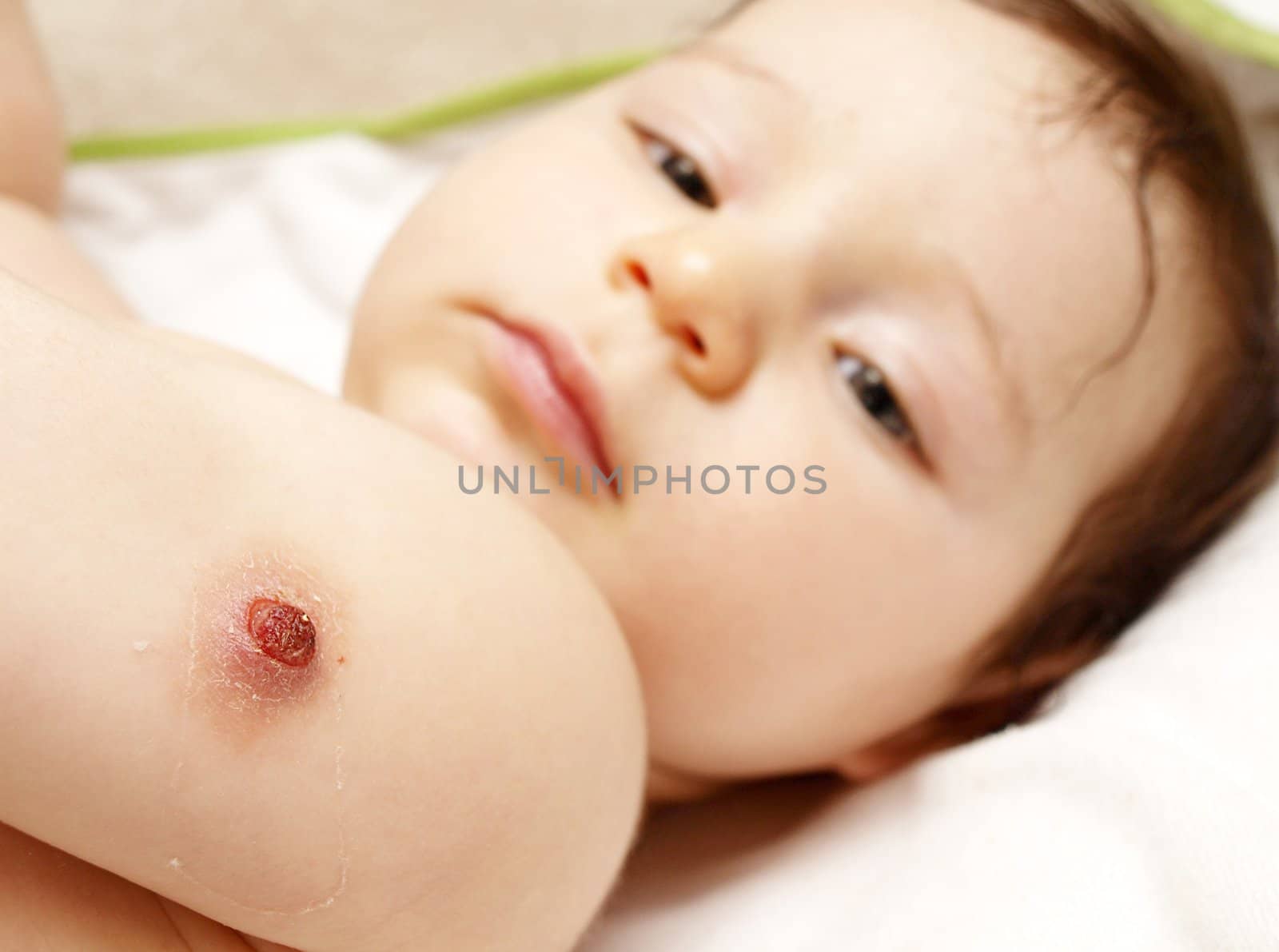 Cute baby girl laying on back, with BCG vaccination wound on shoulder by Arvebettum