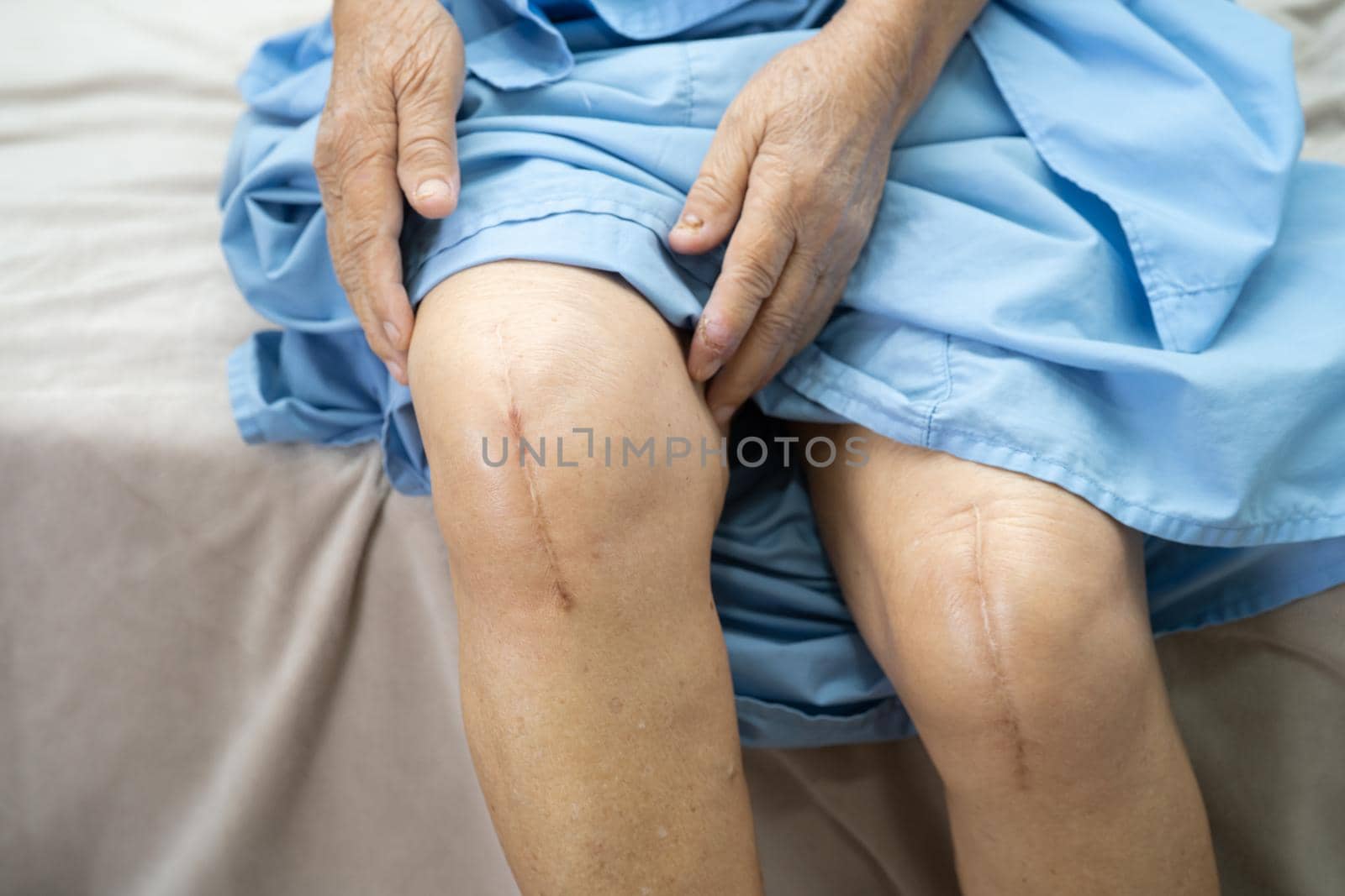 Asian senior or elderly old lady woman patient show her scars surgical total knee joint replacement Suture wound surgery arthroplasty on bed in nursing hospital ward, healthy strong medical concept. by pamai
