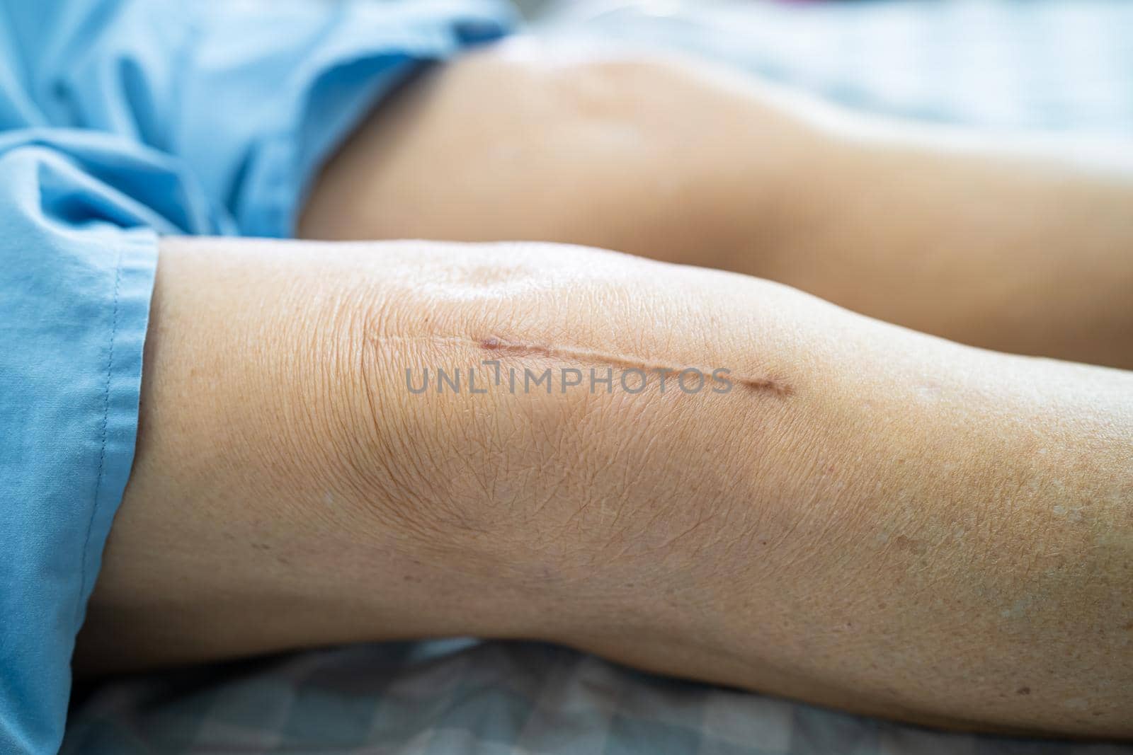 Asian senior or elderly old lady woman patient show her scars surgical total knee joint replacement Suture wound surgery arthroplasty on bed in nursing hospital ward, healthy strong medical concept. by pamai