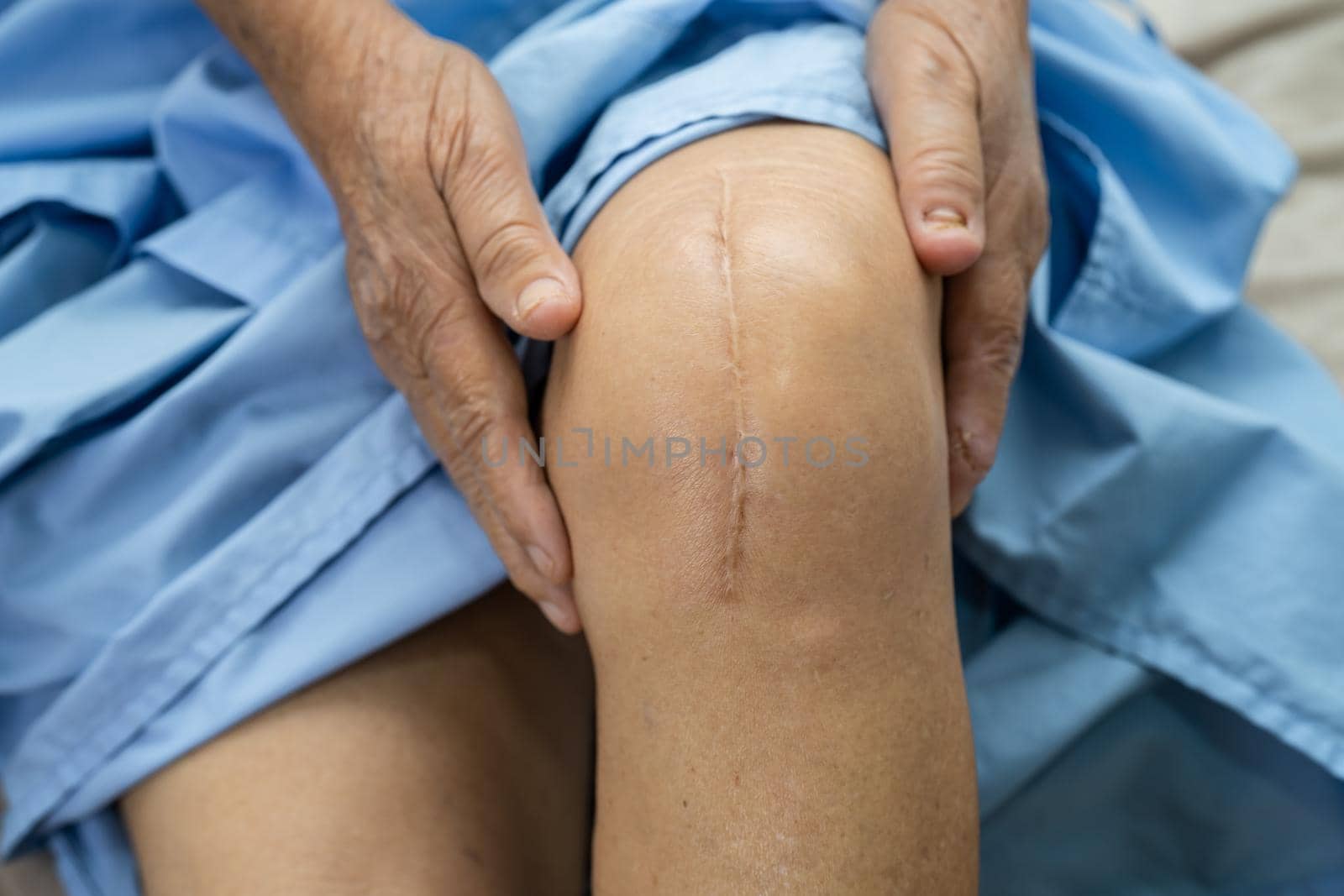 Asian senior or elderly old lady woman patient show her scars surgical total knee joint replacement Suture wound surgery arthroplasty on bed in nursing hospital ward, healthy strong medical concept. by pamai