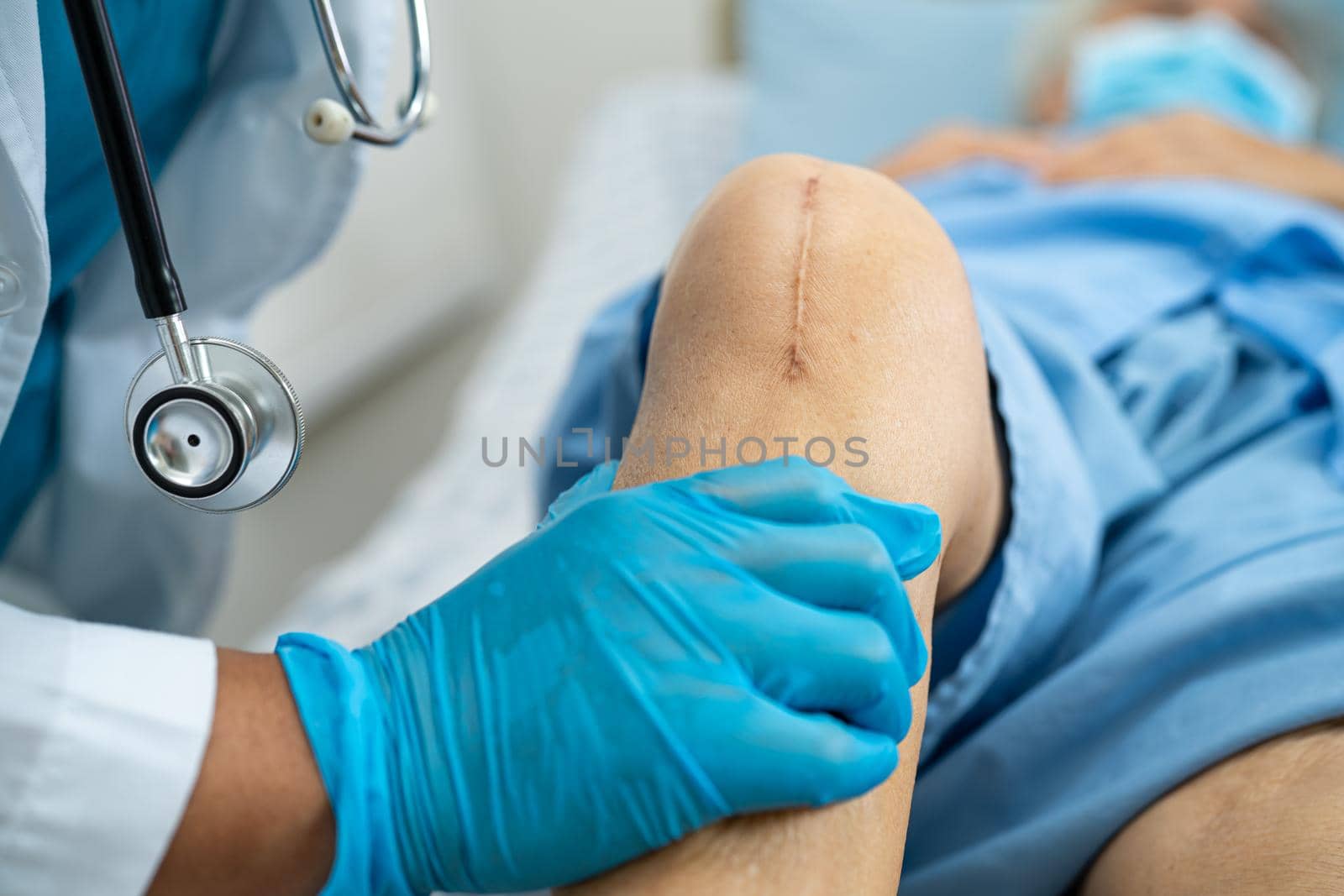 Asian senior or elderly old lady woman patient show her scars surgical total knee joint replacement Suture wound surgery arthroplasty on bed in nursing hospital ward, healthy strong medical concept. by pamai