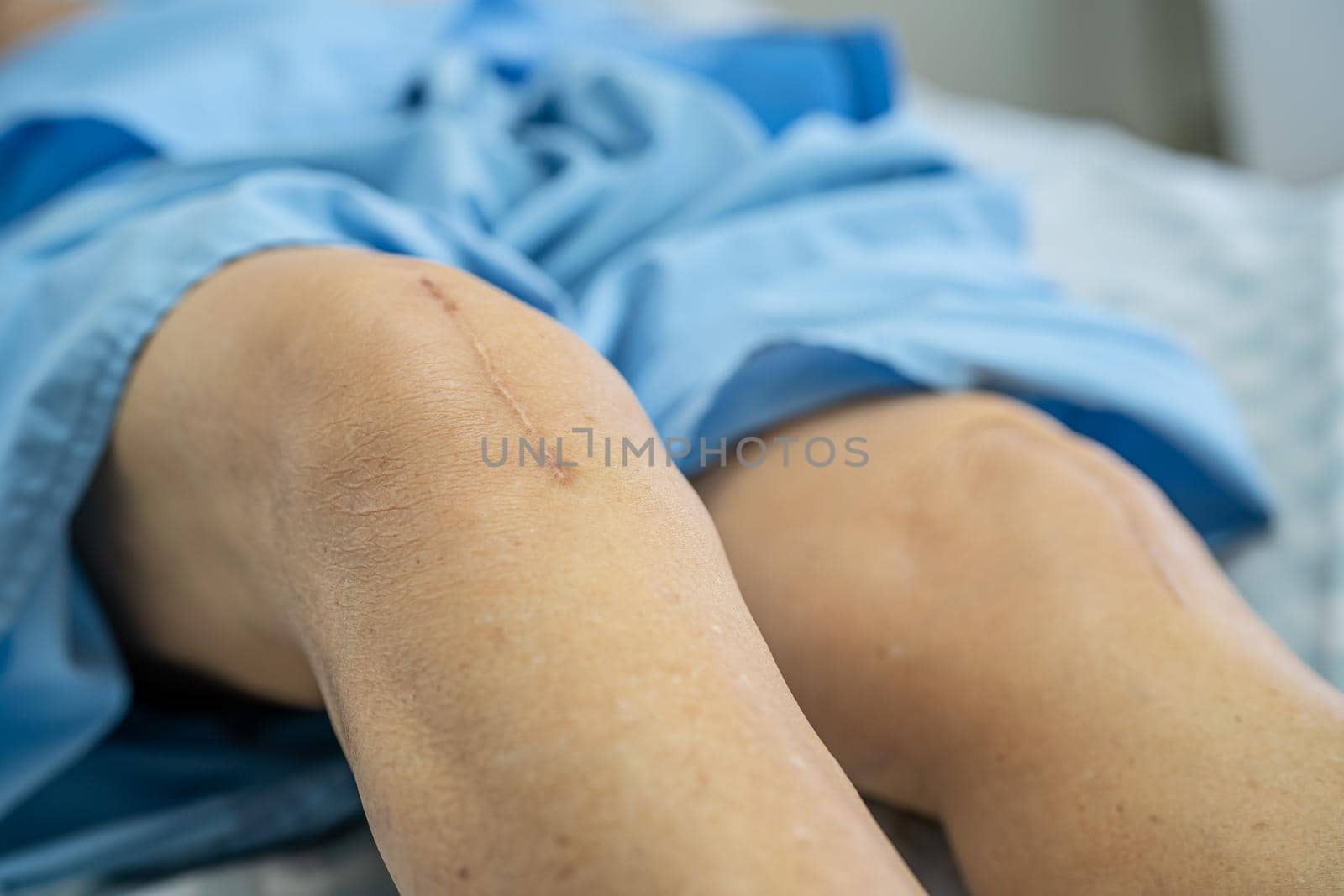 Asian senior or elderly old lady woman patient show her scars surgical total knee joint replacement Suture wound surgery arthroplasty on bed in nursing hospital ward, healthy strong medical concept.