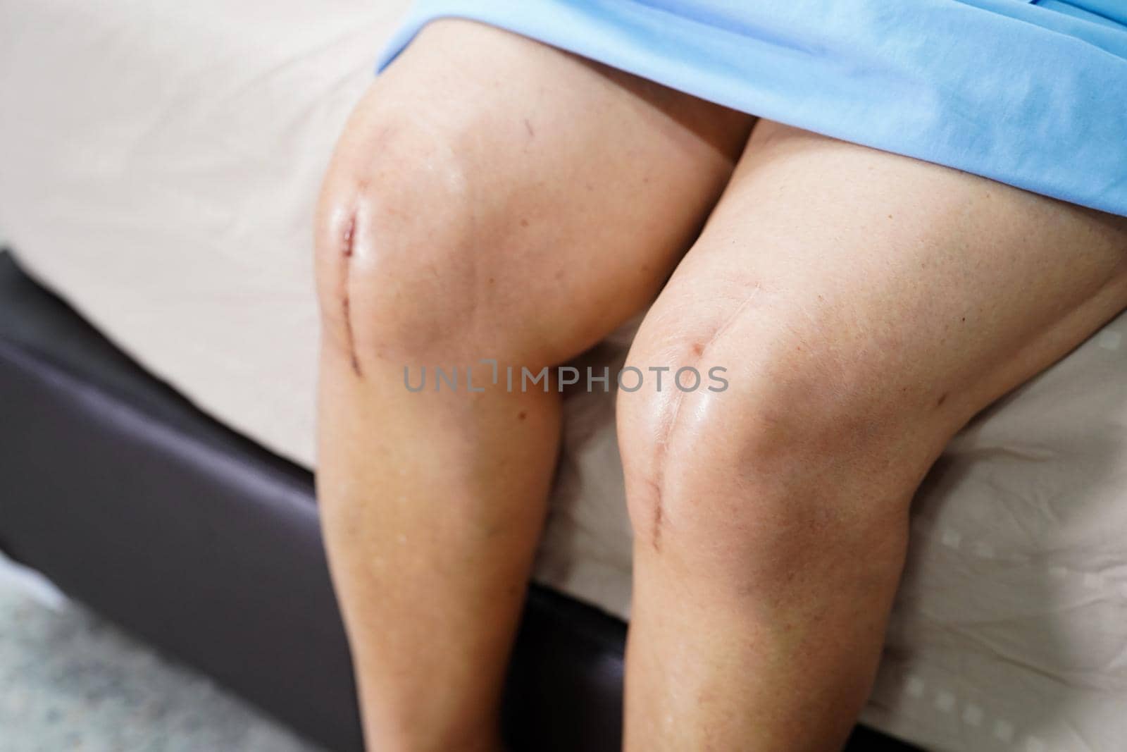 Asian senior or elderly old lady woman patient show her scars surgical total knee joint replacement Suture wound surgery arthroplasty on bed in nursing hospital ward, healthy strong medical concept. by pamai