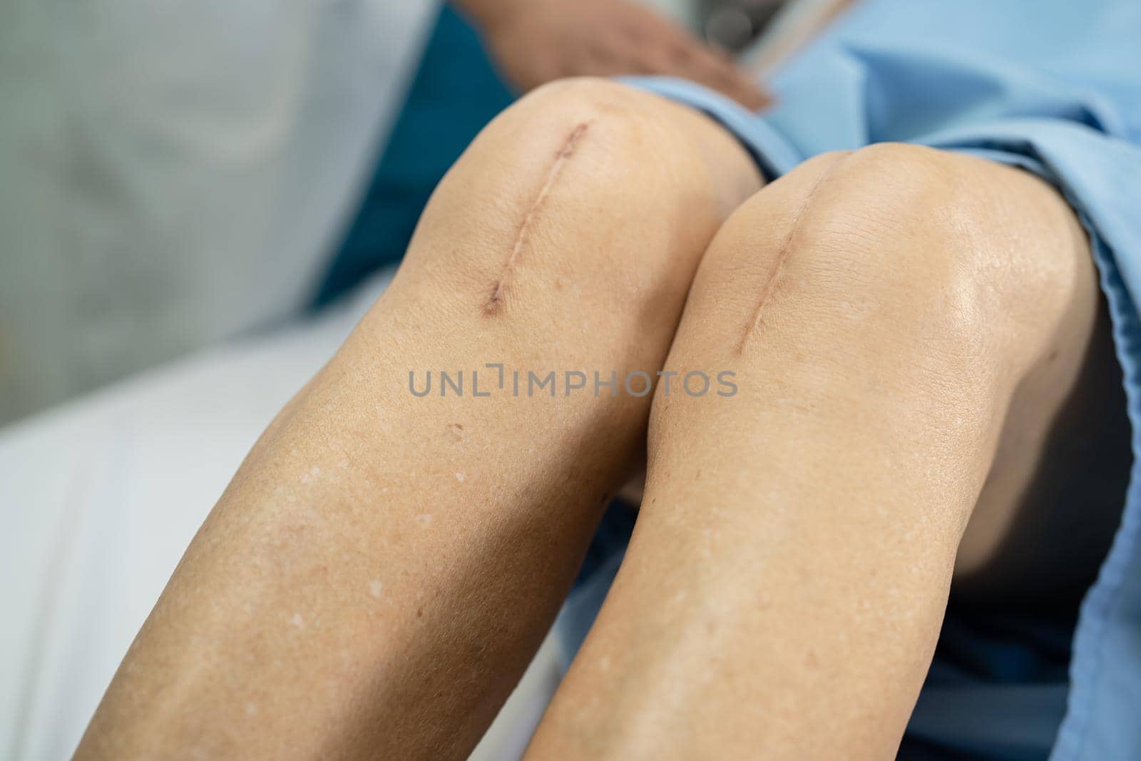 Asian senior or elderly old lady woman patient show her scars surgical total knee joint replacement Suture wound surgery arthroplasty on bed in nursing hospital ward, healthy strong medical concept.