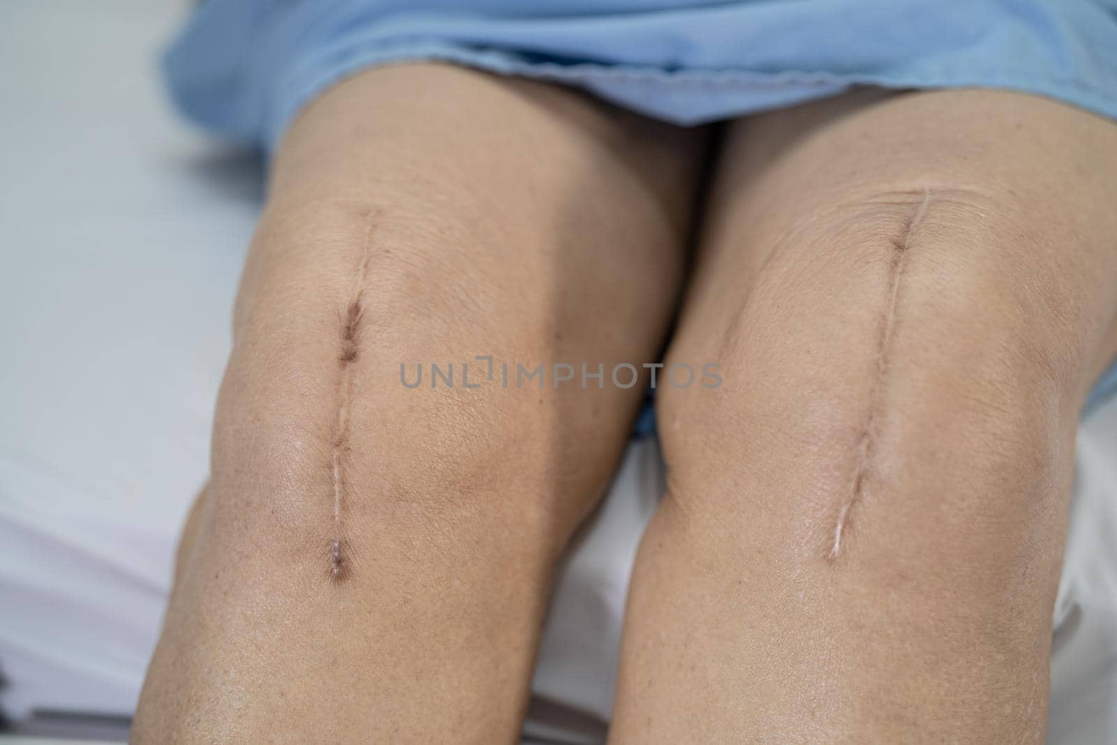 Asian senior or elderly old lady woman patient show her scars surgical total knee joint replacement Suture wound surgery arthroplasty on bed in nursing hospital ward, healthy strong medical concept. by pamai