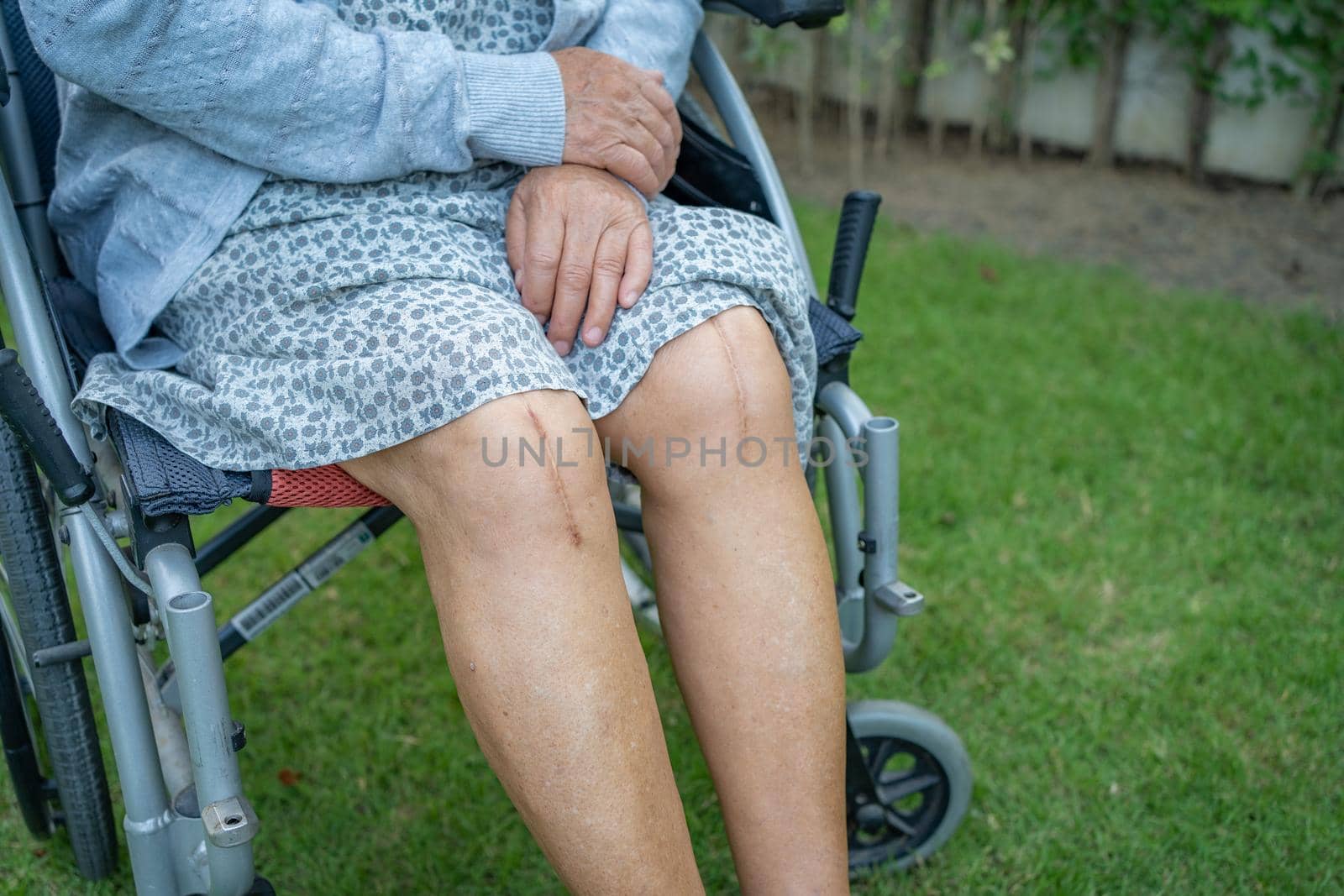 Asian senior or elderly old lady woman patient show her scars surgical total knee joint replacement Suture wound surgery arthroplasty on bed in nursing hospital ward, healthy strong medical concept.