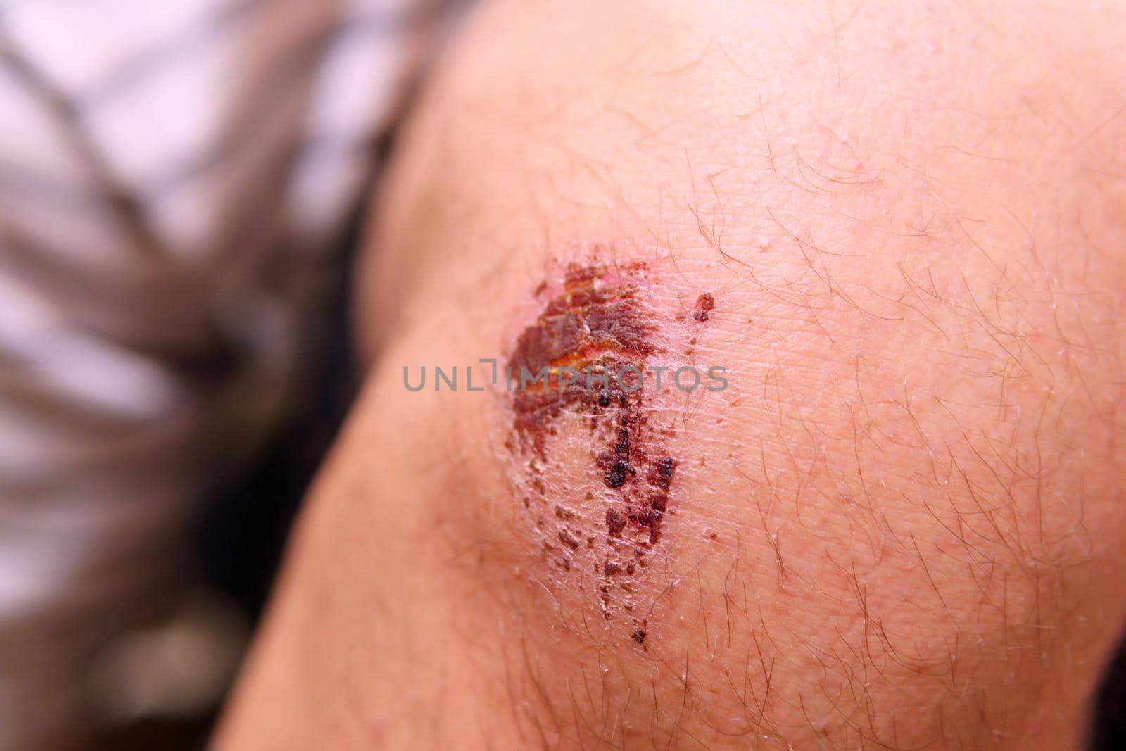 Deep scratches on the skin with bruises on knee. close-up selective focus by darksoul72