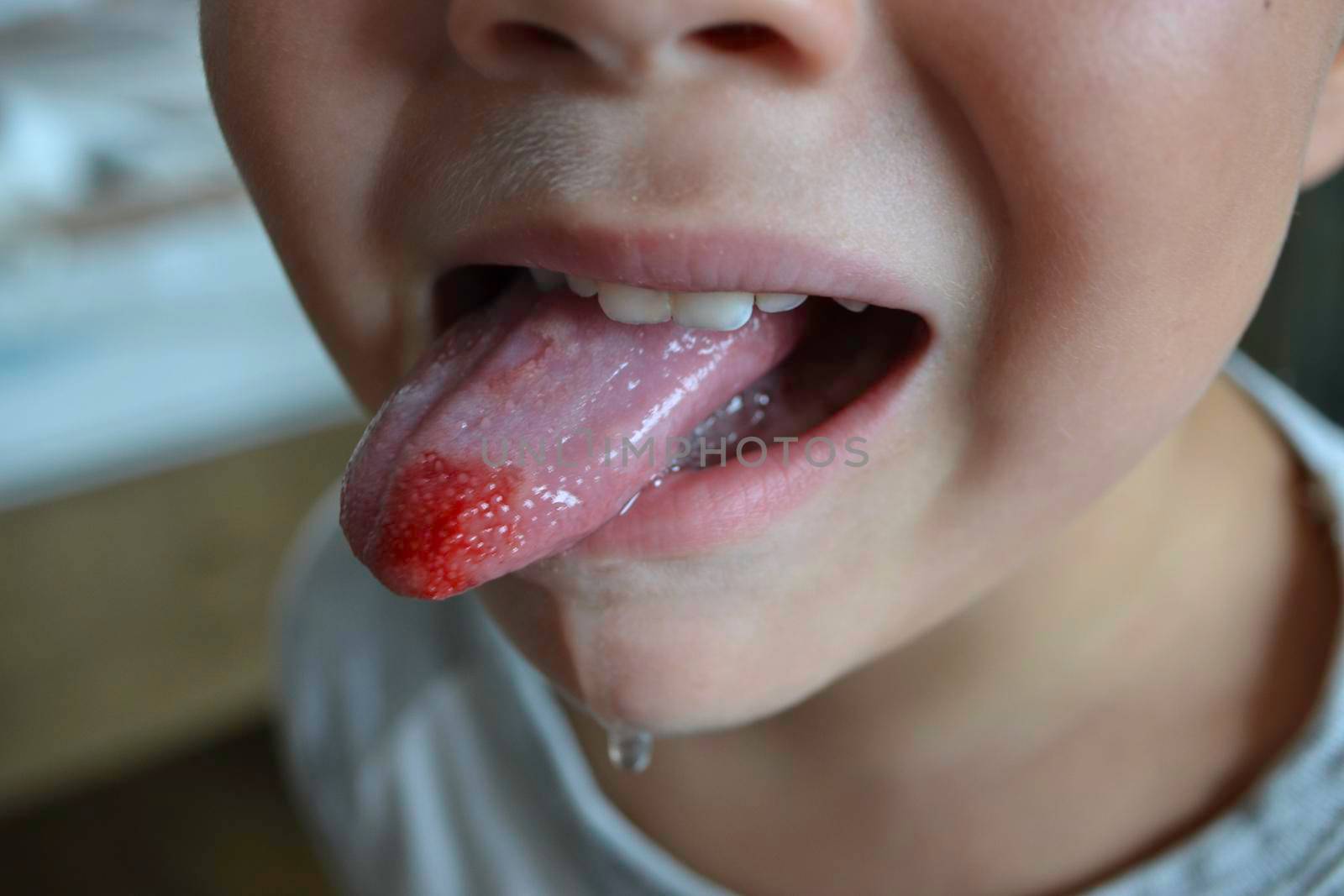 Close-up of lips, tongue, protrusion of blood. Child's bitten tongue. by milastokerpro