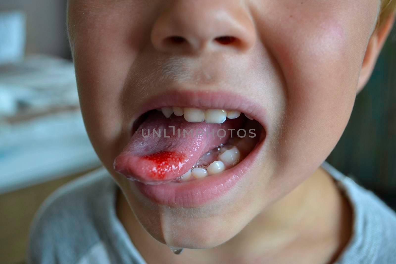 Close-up of lips, tongue, protrusion of blood. Child's bitten tongue. High quality photo