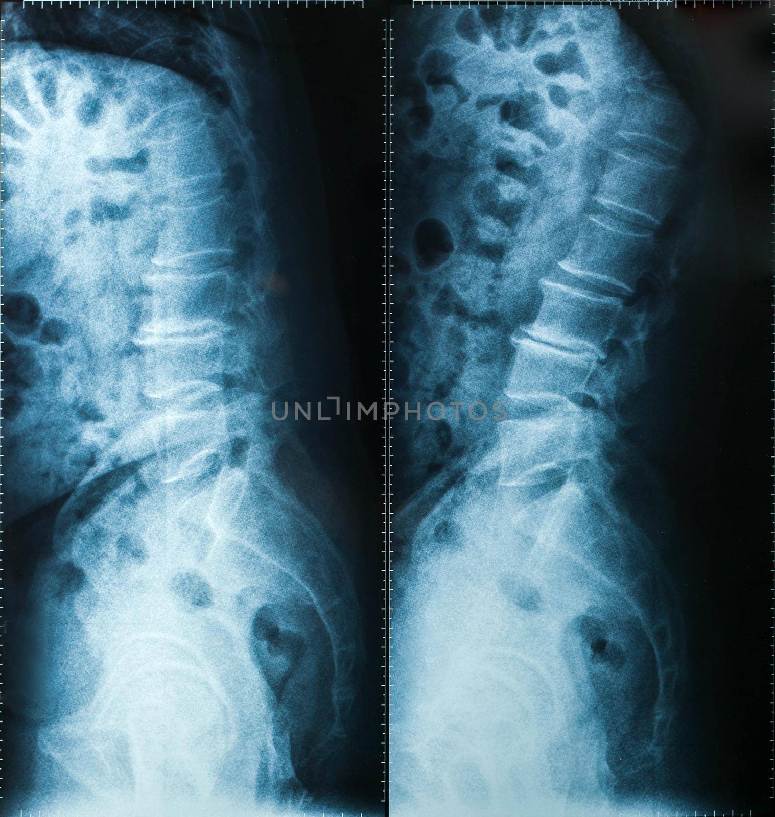 X-Ray image, View of neck men for medical diagnosis.