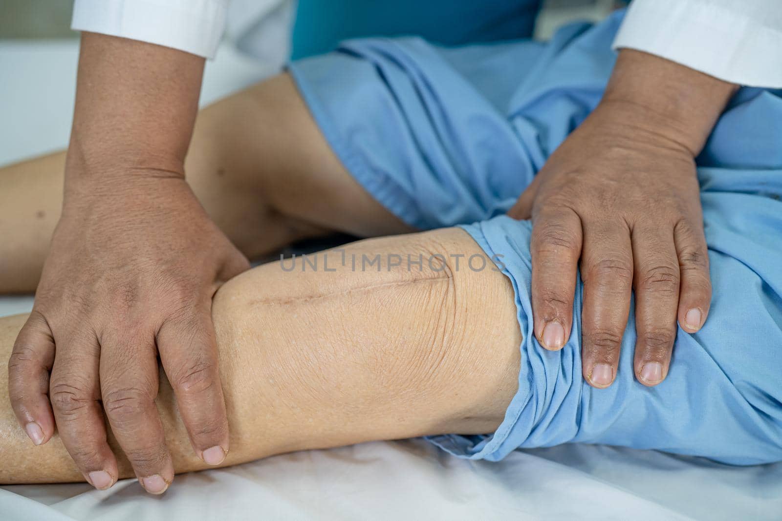 Asian senior or elderly old lady woman patient show her scars surgical total knee joint replacement Suture wound surgery arthroplasty on bed in nursing hospital ward, healthy strong medical concept.