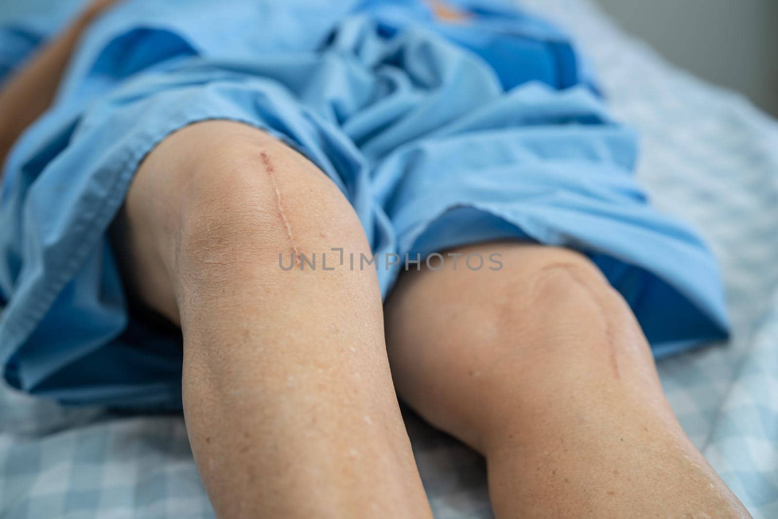 Asian senior or elderly old lady woman patient show her scars surgical total knee joint replacement Suture wound surgery arthroplasty on bed in nursing hospital ward, healthy strong medical concept. by pamai