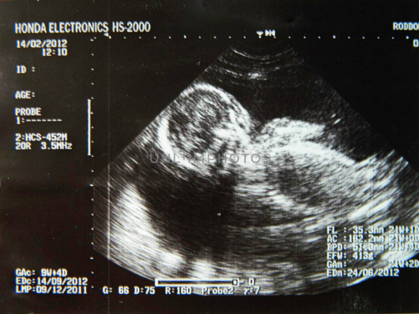 Obstetric Ultrasonography Ultrasound Echography of a fourth month fetus. High quality photo