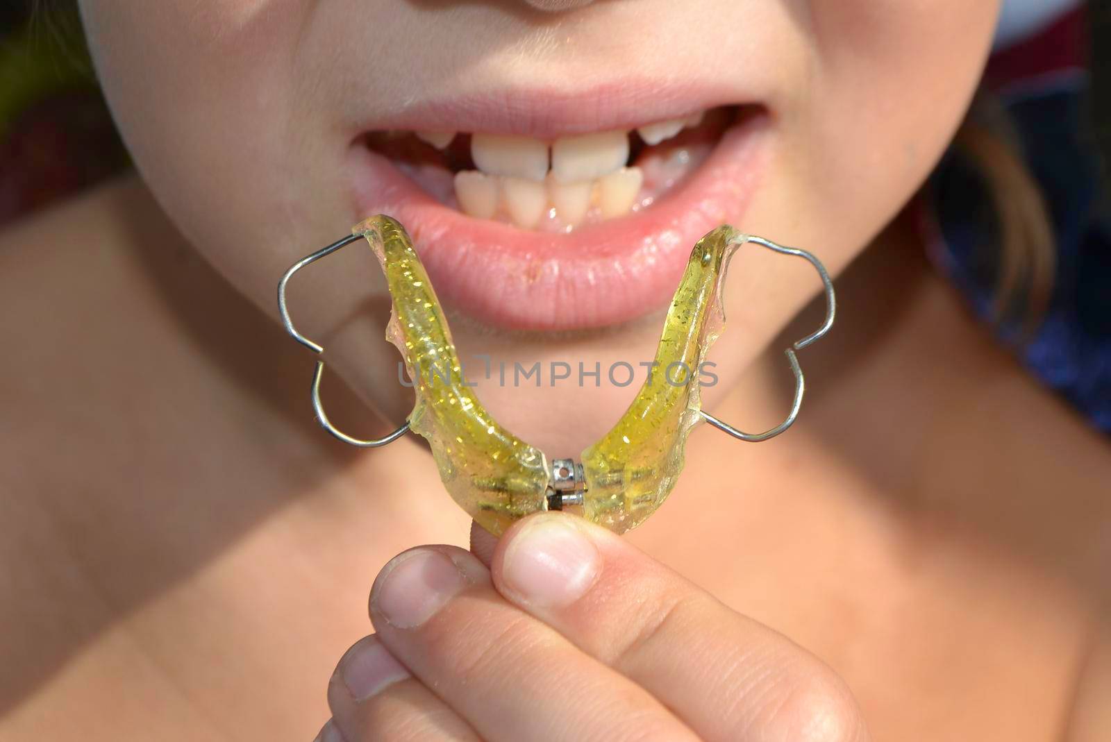 Cropped view of the little girl with her mouth open sitting at the dentist's chair while the orthodontist holding the plate on her teeth. Dentist putting plate at child mouth. High quality photo