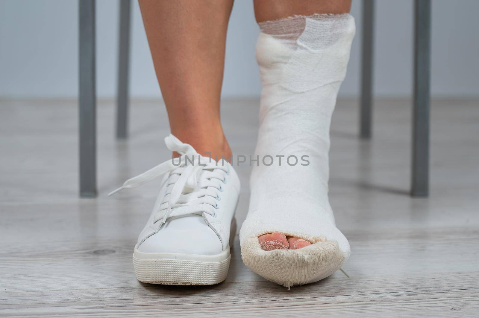 Close-up of female legs with plaster cast. A woman with a broken leg sits on a chair.
