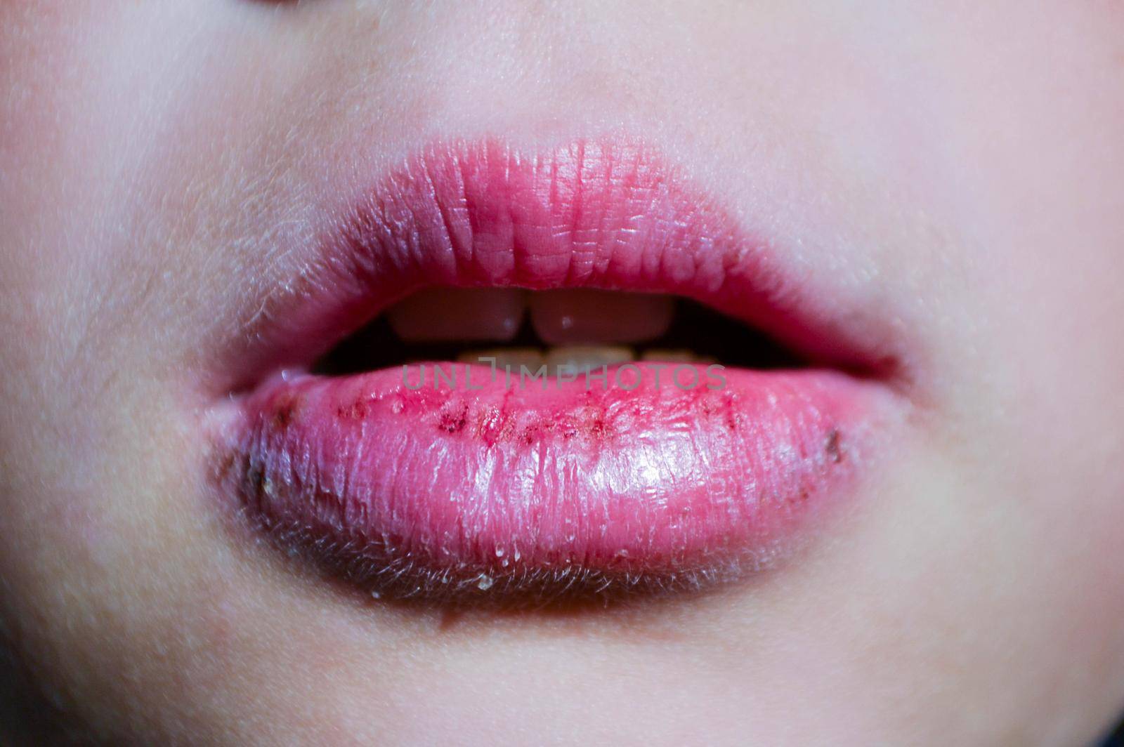 Cracked lips caused wound on the corner of the lips: dry skin problem with mouth disease, Angular cheilitis close up of chapped. High quality photo