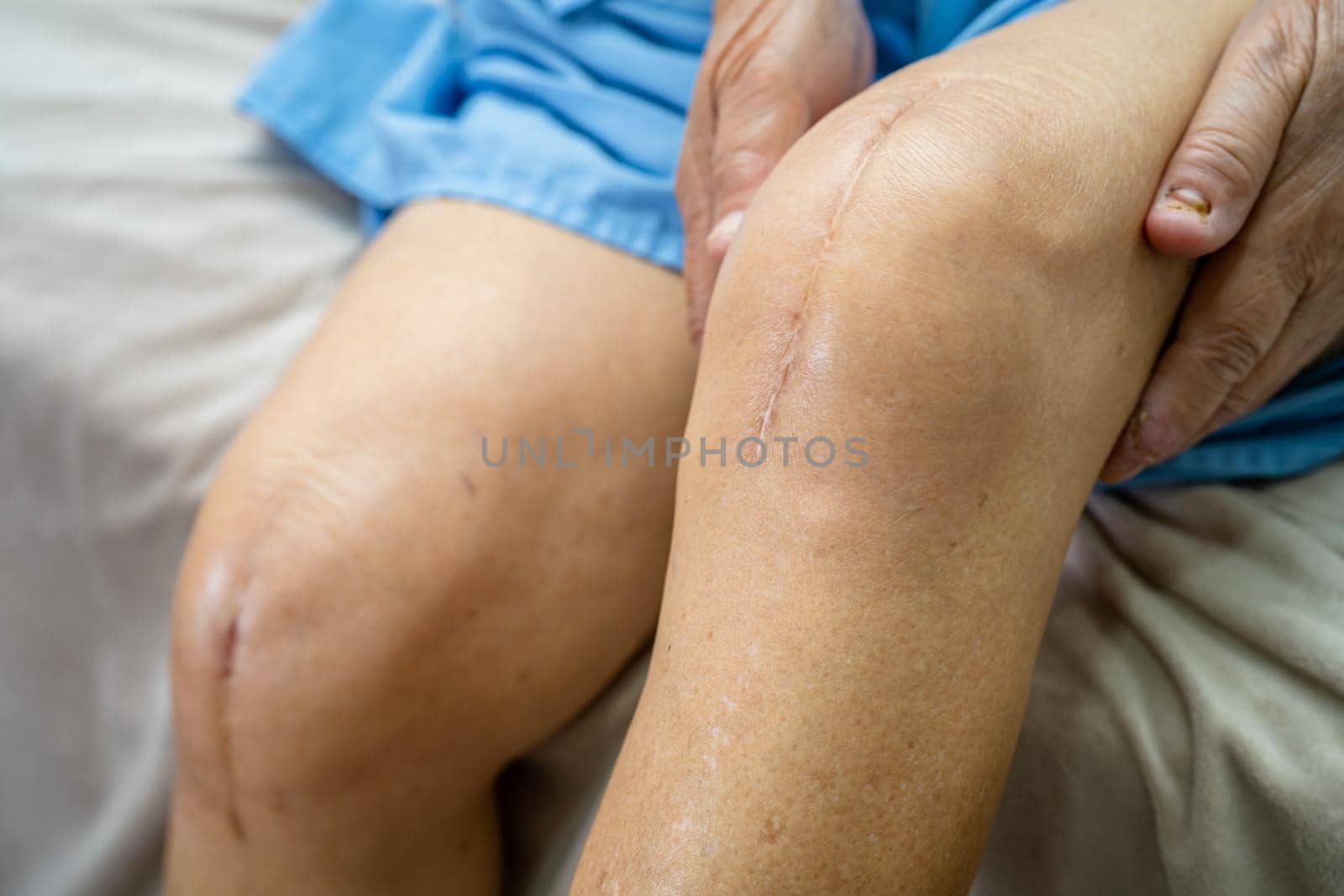 Asian senior or elderly old lady woman patient show her scars surgical total knee joint replacement Suture wound surgery arthroplasty on bed in nursing hospital ward, healthy strong medical concept.
