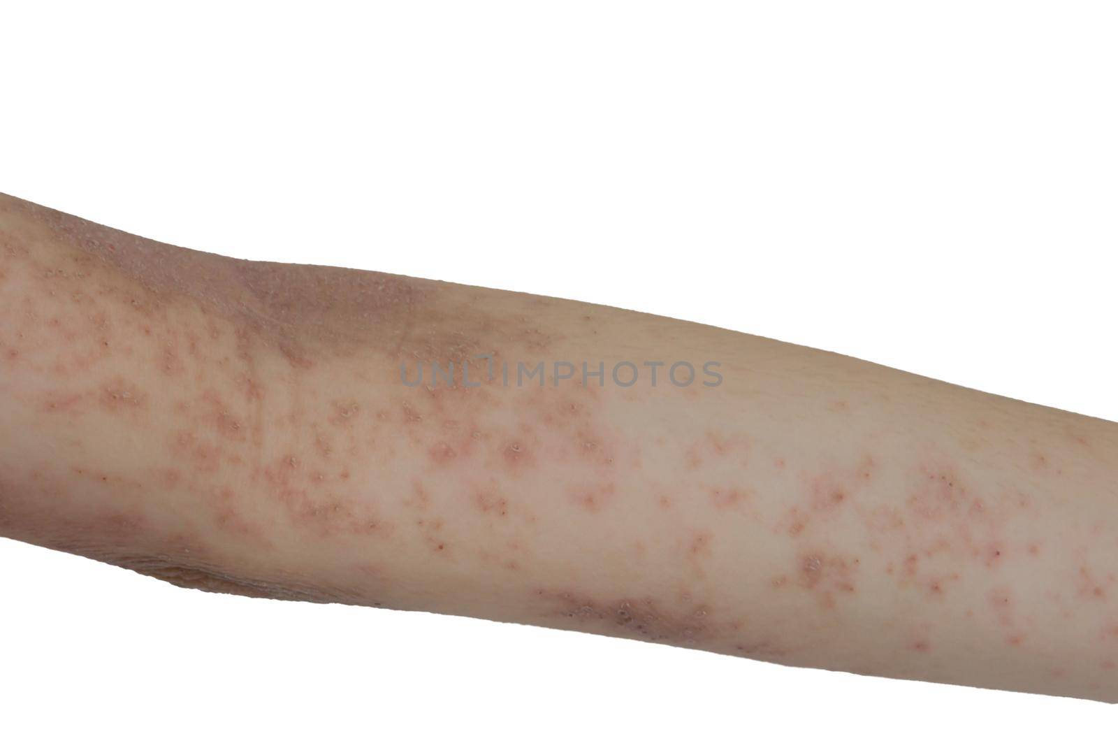 Skin rash on the arms isolated a white background. by aoo3771