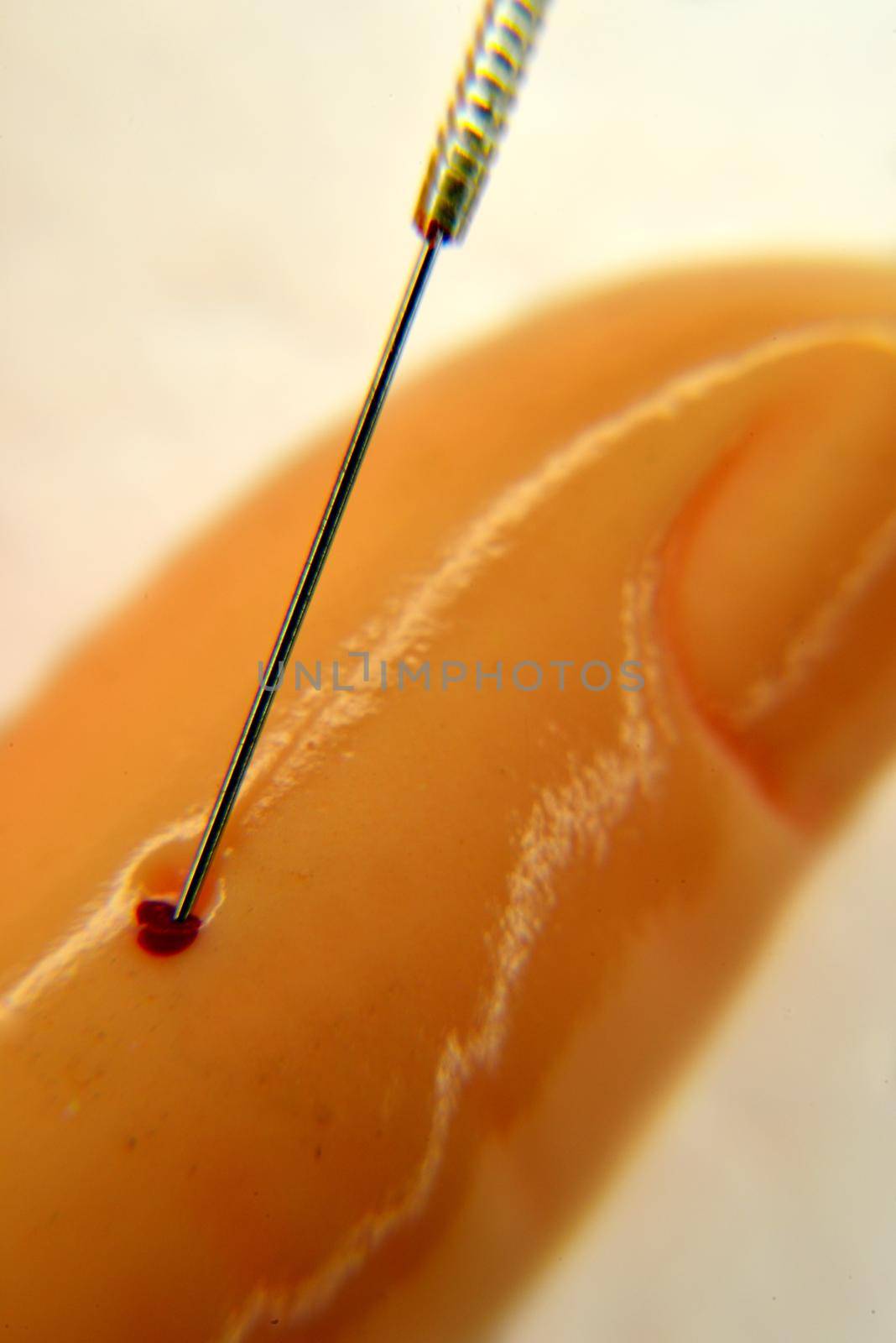 acupuncture demonstration on hand model