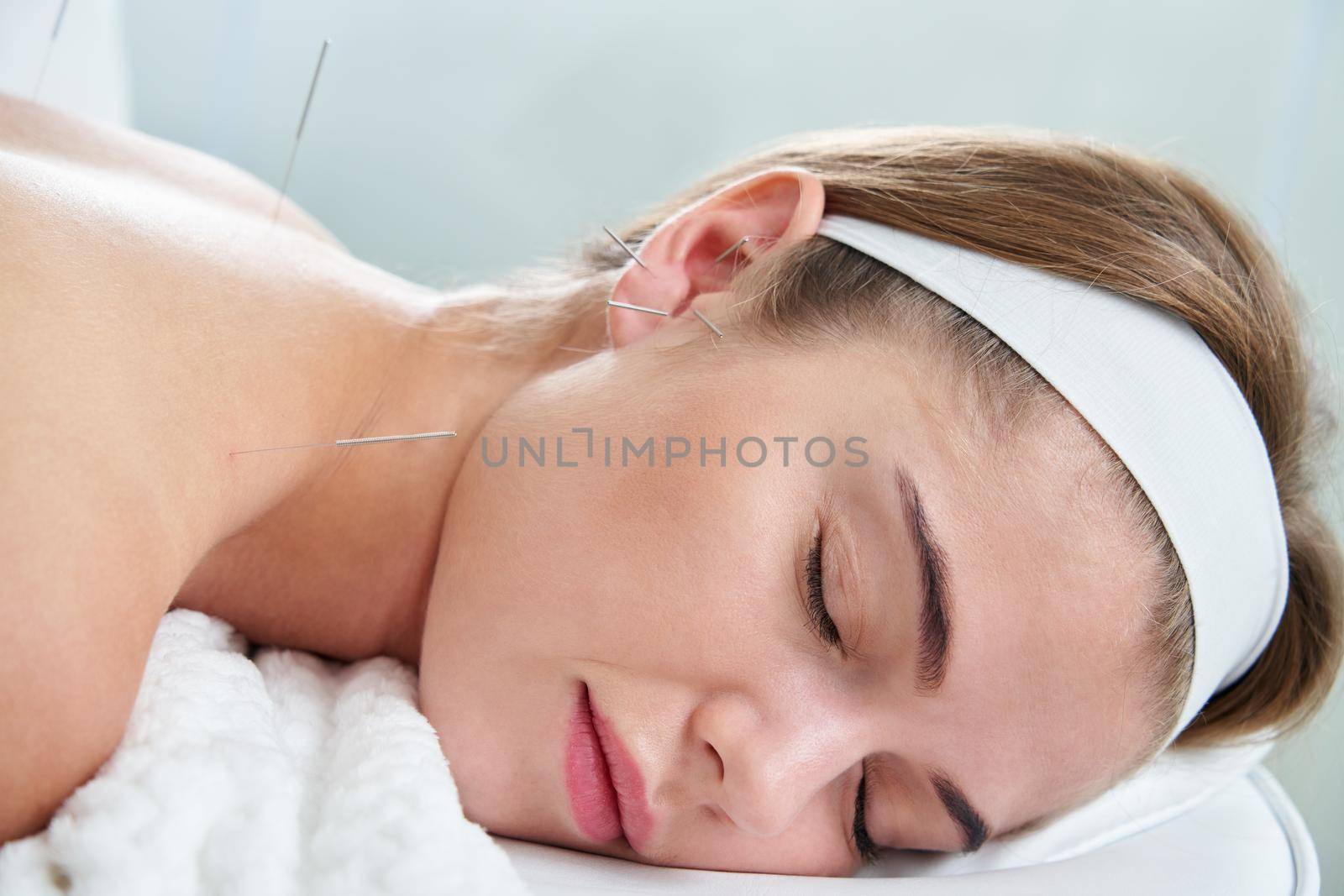 Beautiful young woman relaxing on a bed having acupuncture treatment with needles in and around her ear. Alternative Therapy concept