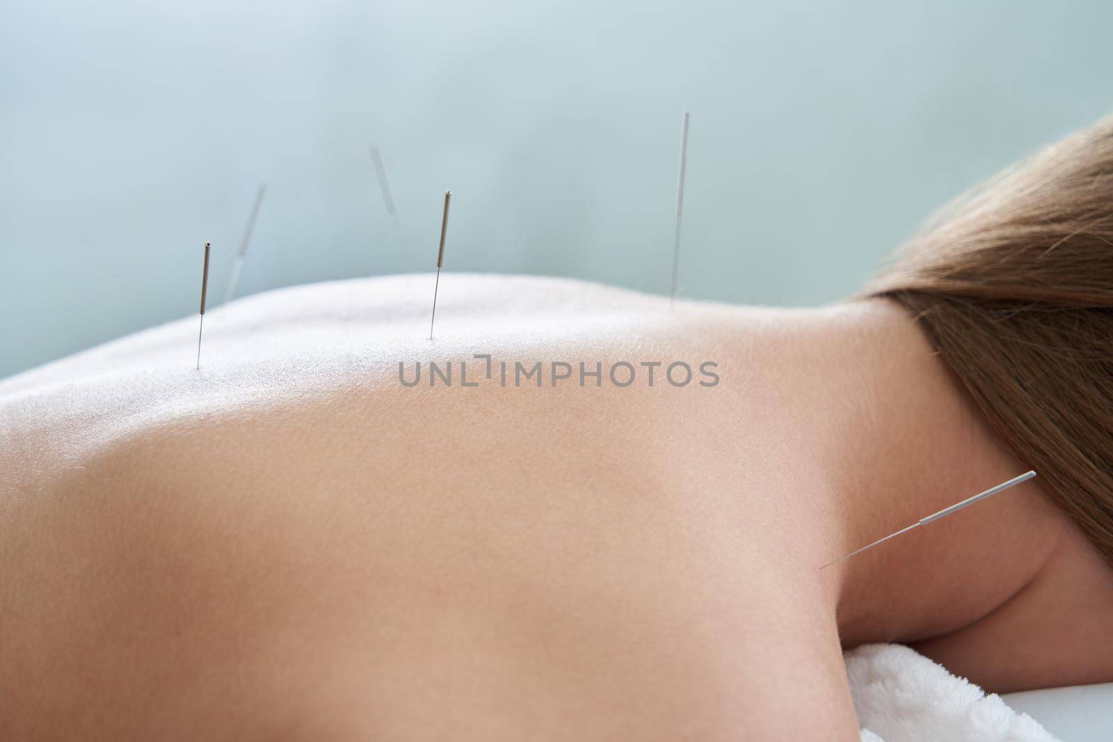 Female back with needles on the acupuncture treatment therapy in a spa salon. Alternative Medicine concept