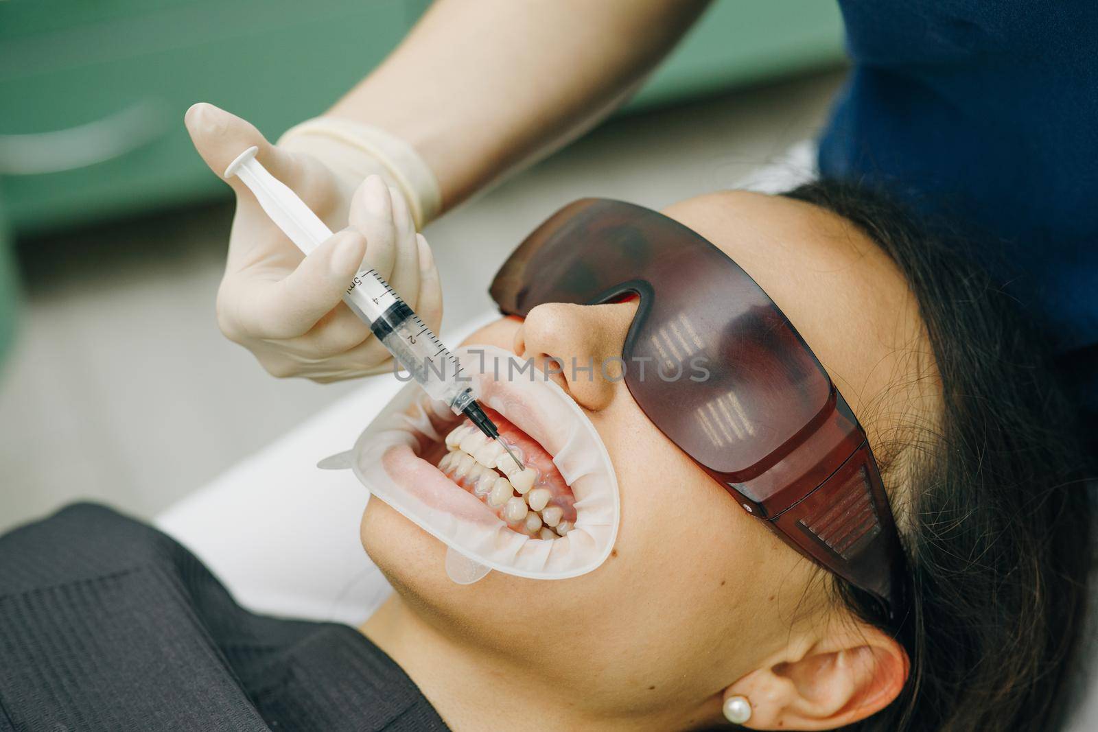 Young woman with an expander in mouth at the dental clinic. Beautiful smile. The health of teeth. Dentist stomatologist whitening teeth for patient in medicine dental clinic