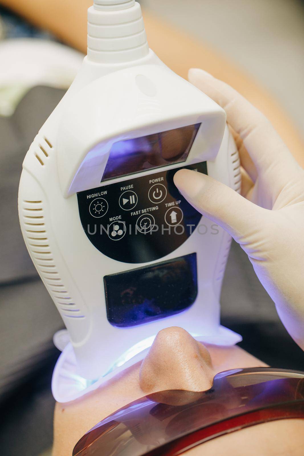 Teeth whitening using an ultraviolet lamp. Dentist doing teeth whitening procedure with ultraviolet lamp. Concept of teeth care and dentistry. by uflypro