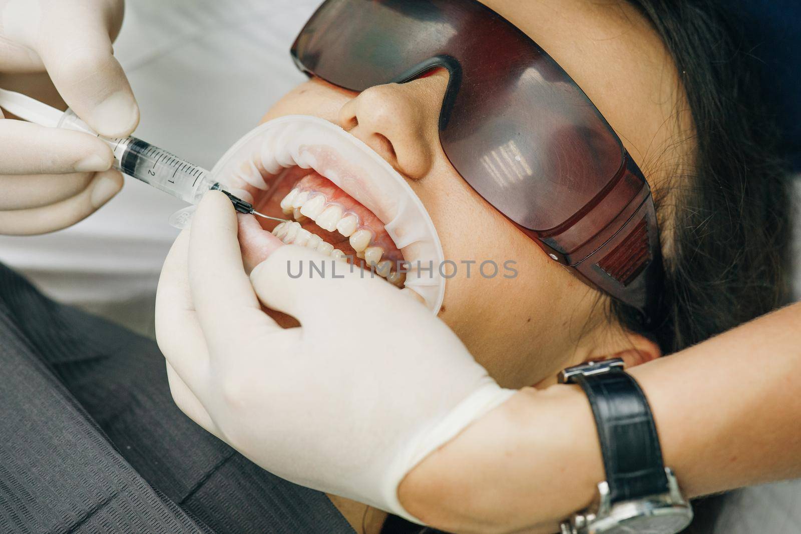Application of protective whitening gel to the teeth. Woman with an expander in mouth at the dental clinic. Beautiful smile. The health of teeth. Dentist stomatologist whitening teeth for patient. by uflypro