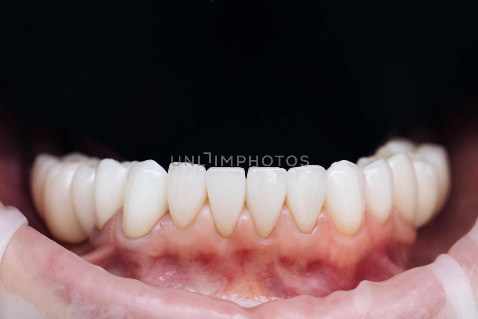 Veneers after fixation. Natural color. Cosmetic dentistry veneers. Modern dental equipment and installation procedure of veneers in dental clinic by uflypro