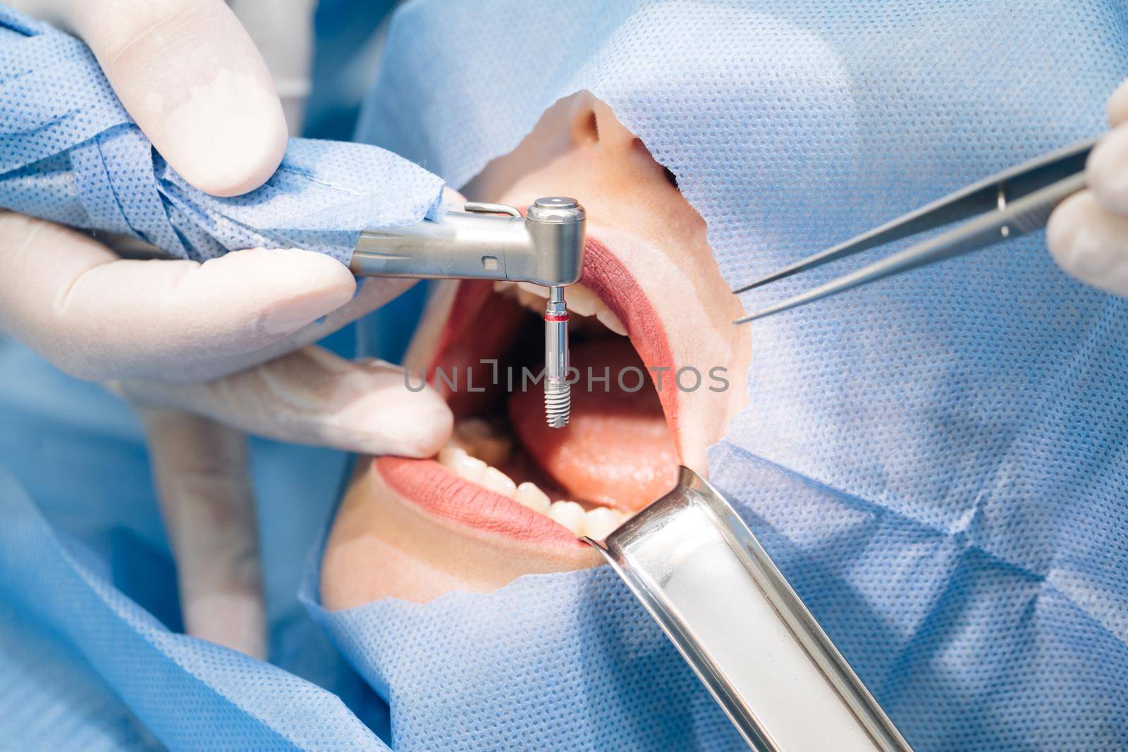 Close-up shot of attentive doctors performing surgical operation installing dental implants into patient's mouth in modern dental clinic. Dental instruments. Stomatology clinic. Dental surgery by uflypro