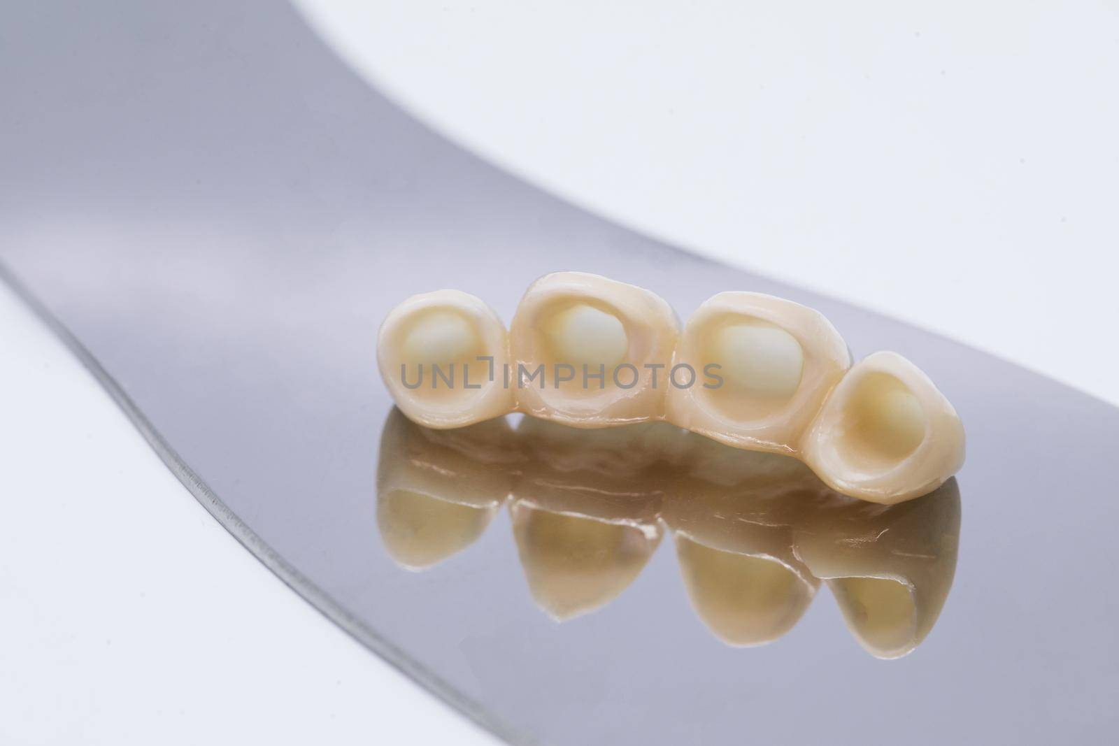 Dental ceramic veneers and crowns. Metal free ceramic dental crowns. by uflypro