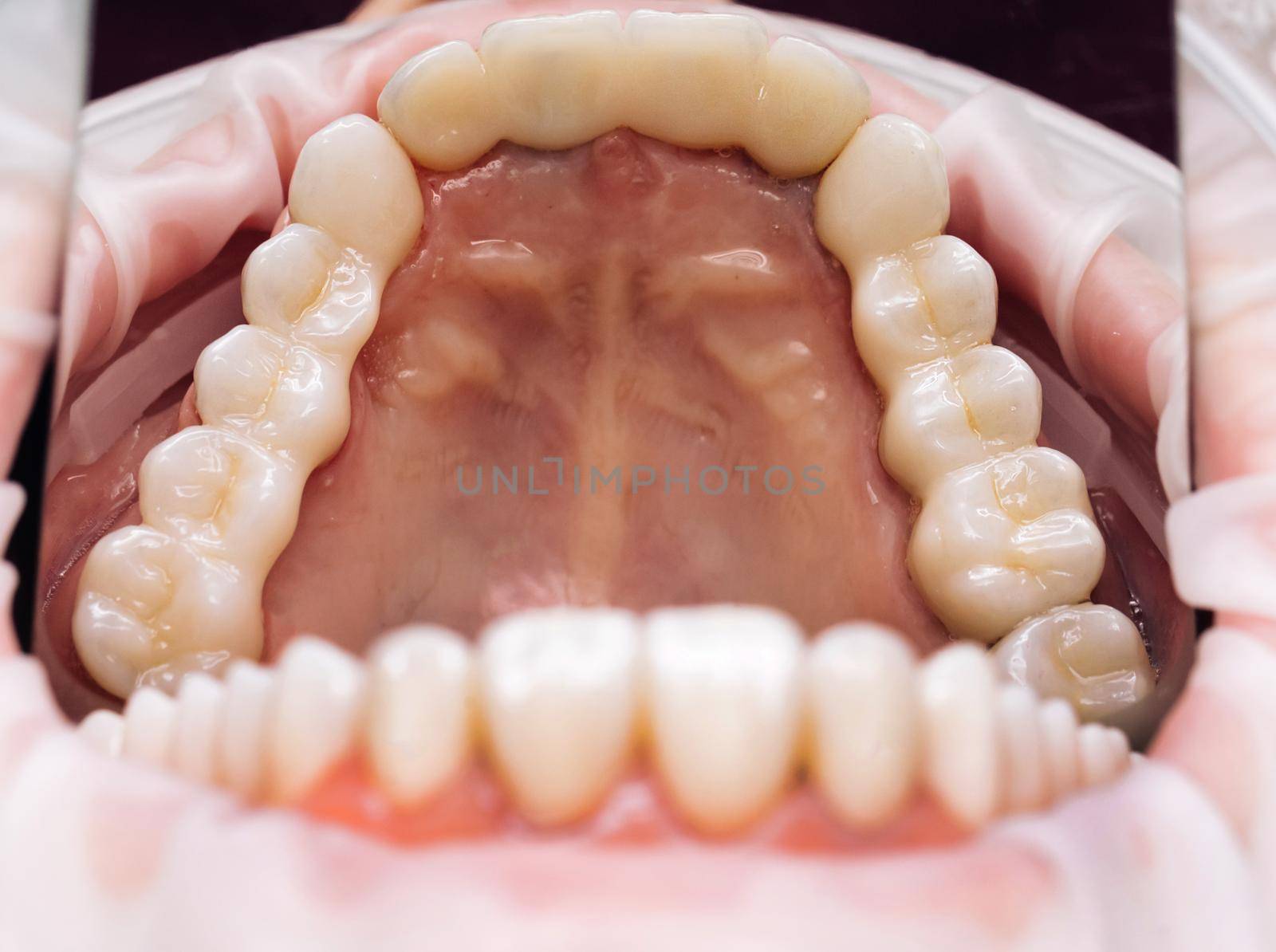 Ceramic teeth dental crowns on model. Ceramic veneers metal free. Metal Free Ceramic crowns on model in dental clinic. Finished new ceramic bridge veneers on model. by uflypro