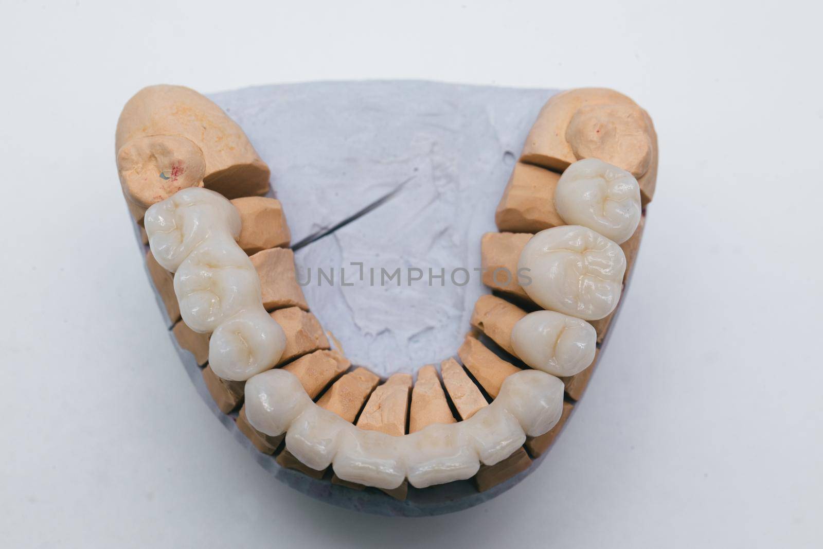Ceramic bridge on plaster model. Zirconium Porcelain Tooth plate in Dentist Store