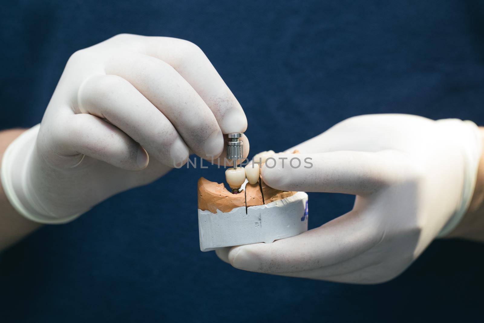 Concept of orthopedic dentistry. Ceramic teeth with the implant on a plaster model. Prosthetics on dental implants. Ceramic bridge on implants. Dentist's hand holds a plaster jaw with dental abutments