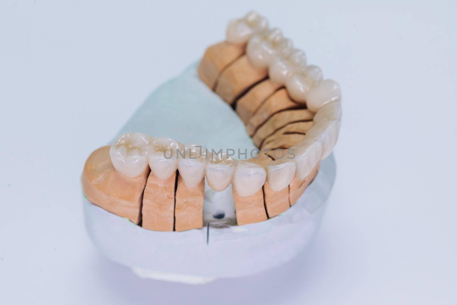 Plaster model of artificial jaw with veneers on the gypsum background. Concept of aesthetic dentistry and design of veneers. Ceramic tooth crown veneers.