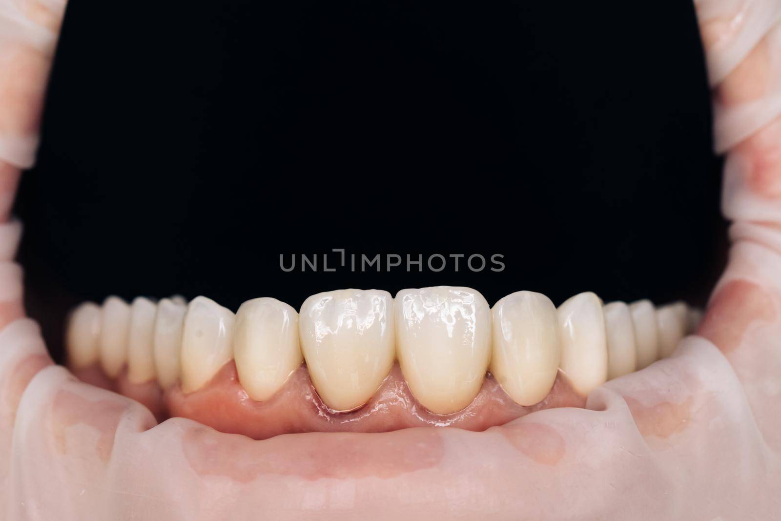 Closeup photo with zirconium artificial teeth. Zirconium crowns. Dental health care. Ceramic zirconium in final version. Staining and glazing. Precision design and high quality materials by uflypro