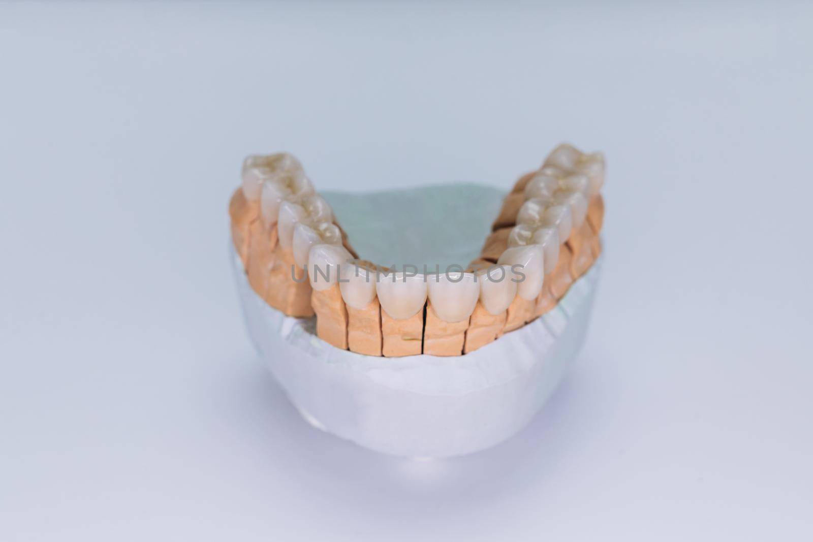 Zirconium crowns veneers. Ceramic teeth with the veneers on a plaster model isolated on white background. Ceramic bridge on plaster model by uflypro