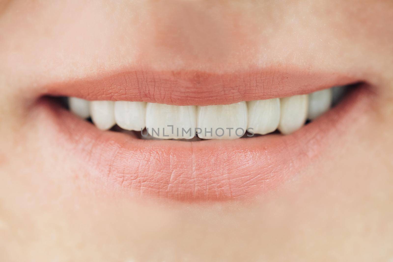 Ceramic crowns of human teeth closeup macro. The concept aesthetic dentistry. by uflypro