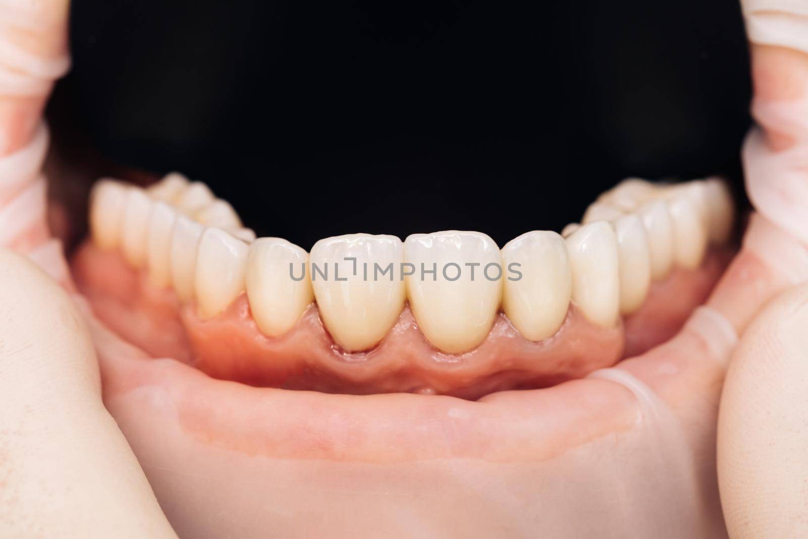 Ceramic crowns of human teeth closeup macro. The concept aesthetic dentistry. Zirconia bridge with porcelain. Beautiful female teeth macro veneers.