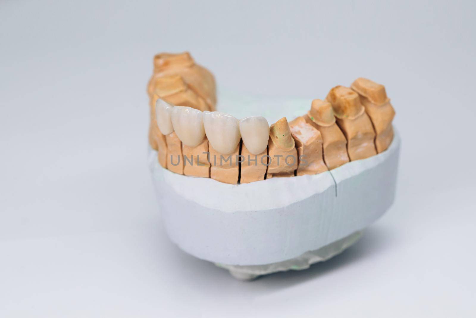 Dental zircon ceramic crowns on model one jaw. Metal free ceramic dental crowns. Dental veneers on on plaster model