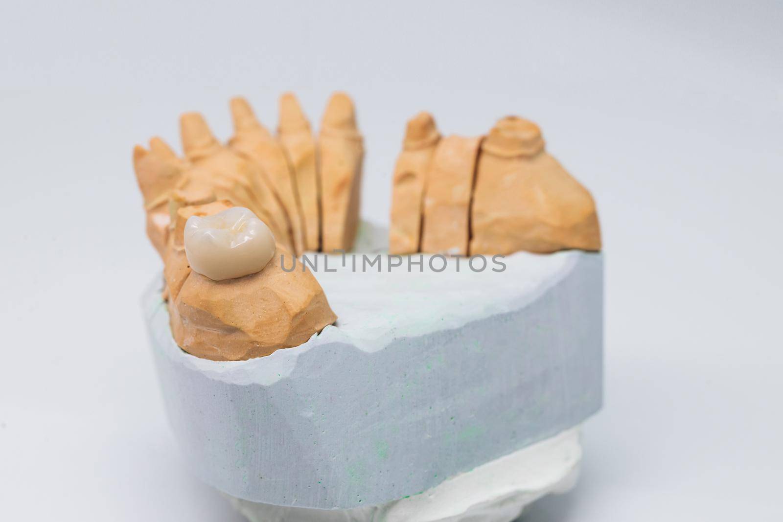Ceramic tooth on a plaster model with a totally wite background. Ceramic teeth with the veneers. Free metal ceramic teeth.