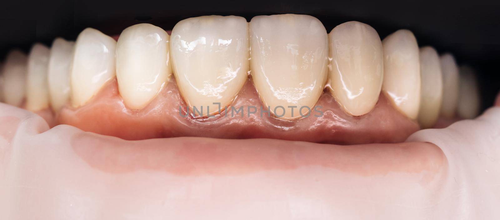 Dental health care. Ceramic zirconium in final version. Precision design and high quality materials. Zirconia bridge with porcelain. Closeup photo with zirconium artificial teeth.