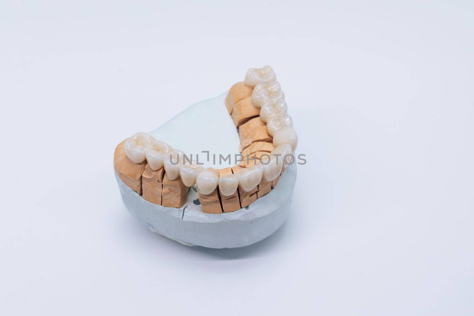 Close-up ceramic crowns veneers on a gypsum model. Illuminated glossy look and natural translucency, effect for hollywood smile makeover. Metal free ceramic dental crowns.