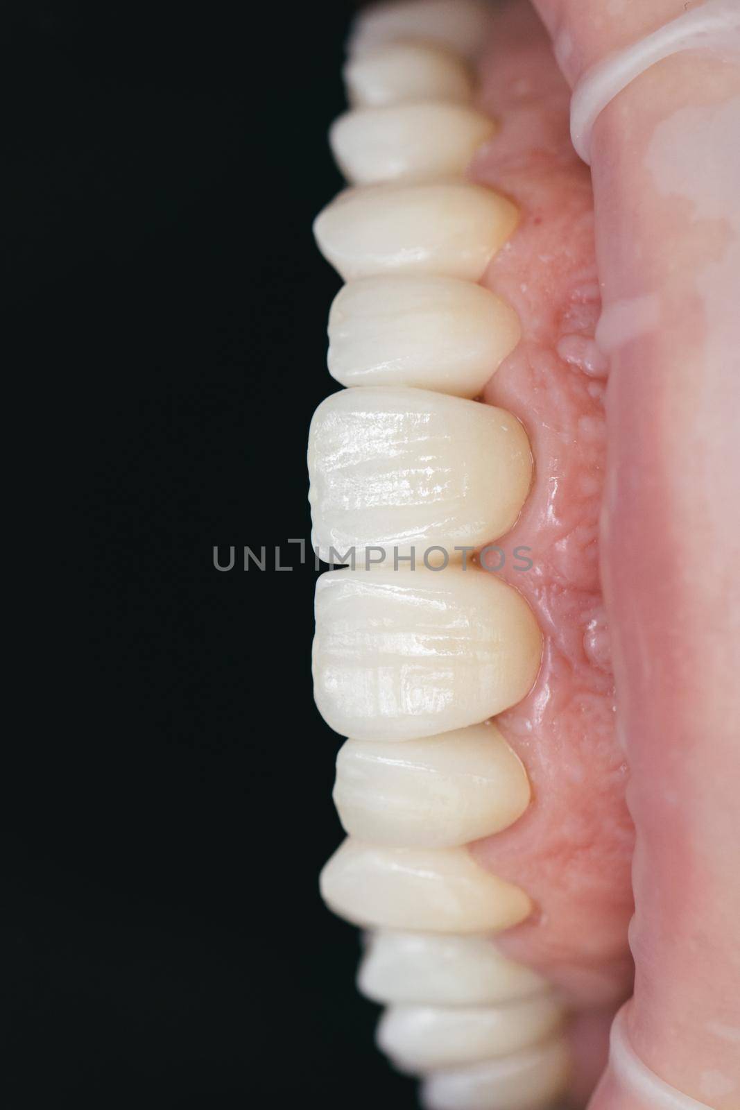 Ceramic zirconium in final version. Staining and glazing. Precision design and high quality materials. Dental health care by uflypro