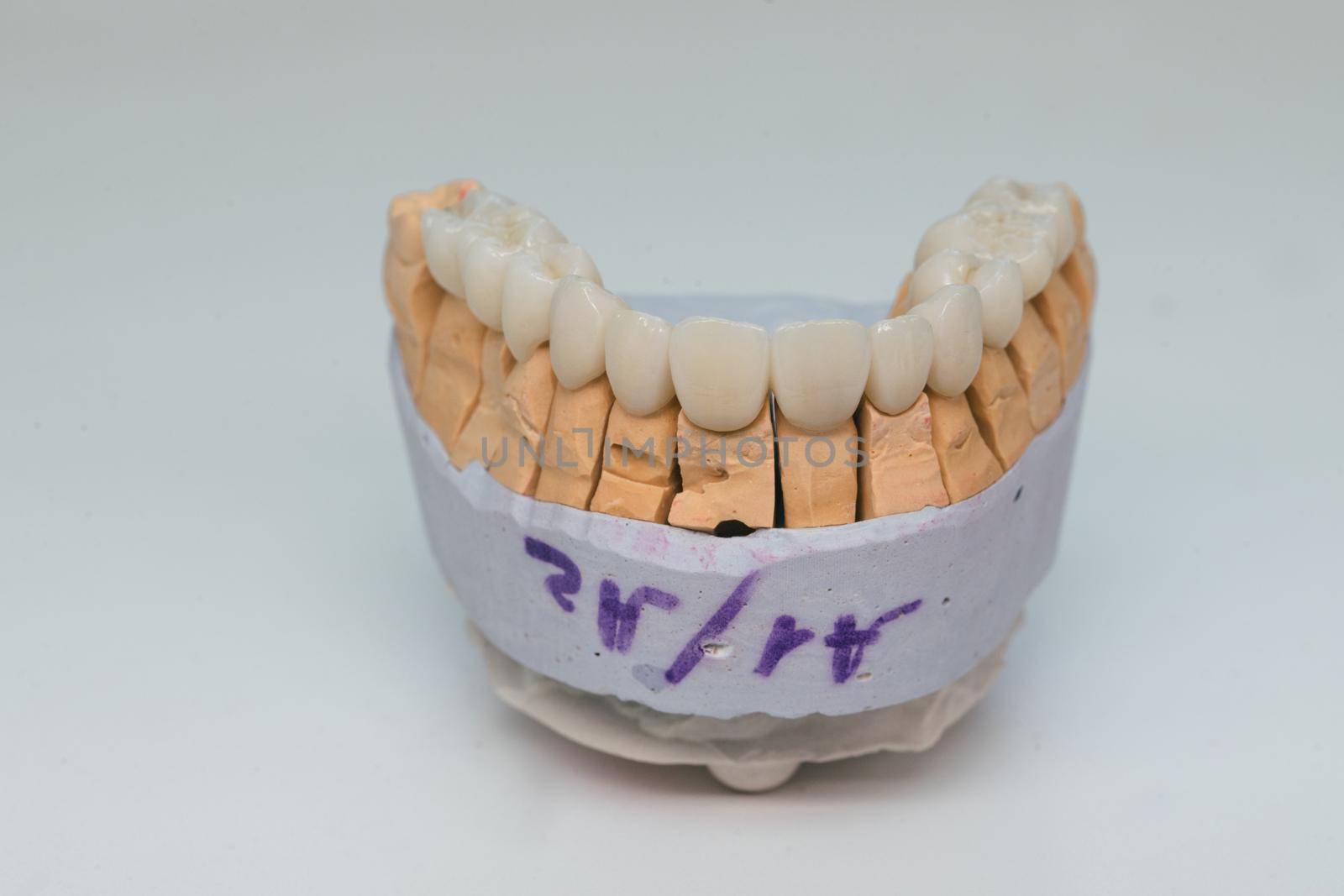 Zirconium crowns. Ceramic teeth with the implant on a plaster model isolated on white background. Ceramic bridge on plaster model